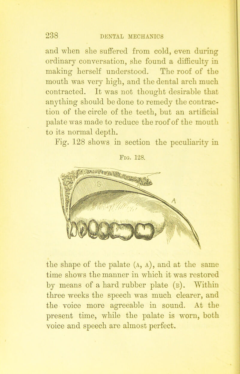 and wlien she suffered from cold, even during ordinary conversation, she found a difficulty in making herself understood. The roof of the mouth was very high, and the dental arch much contracted. It was not thought desirable that anything should be done to remedy the contrac- tion of the circle of the teeth, but an artificial palate was made to reduce the roof of the mouth to its normal depth. Fig. 128 shows in section the peculiarity in Fig. 128. the shape of the palate (a, a), and at the same time shows the manner in which it was restored by means of a hard rubber plate (b). Within three weeks the speech was much clearer, and the voice more agreeable in sound. At the present time, while the palate is worn, both voice and speech are almost perfect.