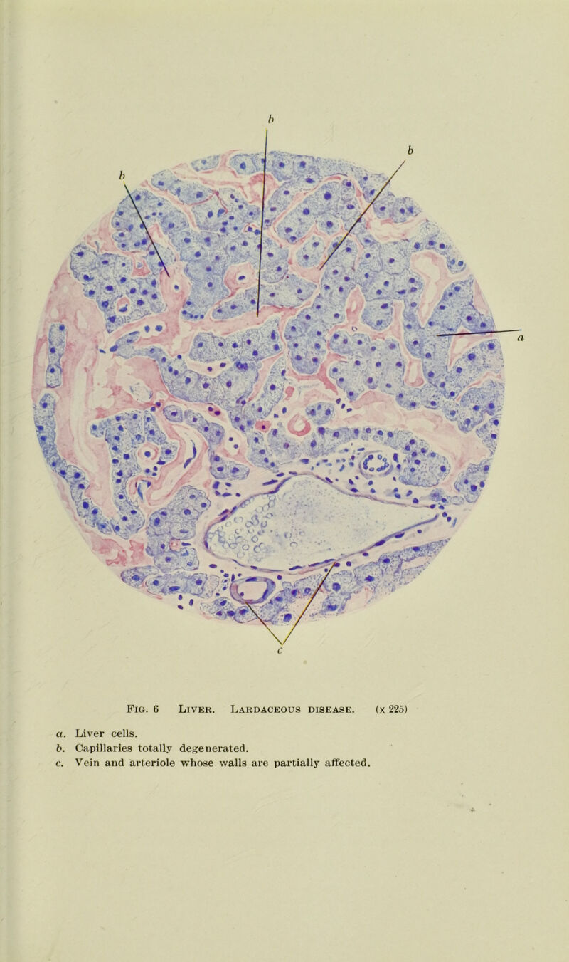 h Fig. 6 Liver. Lakdaceous disease. (x 225) a. Liver cells. b. Capillaries totally degenerated. c. Vein and arteriole whose walls are partially affected. i '‘M