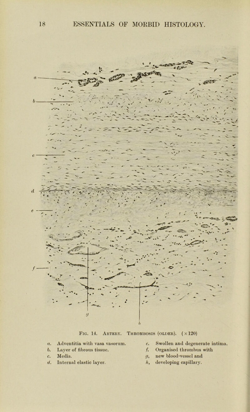 Fig. 14. Artery. Thrombosis (older). (x120) a. Adventitia with vasa vasorum. €. Swollen and degenerate intiina. b. Layei- of fibrous tissue. f. Organised thrombus with c. Media. u. new blood-vessel and d. Internal elastic layer. developing capillary.