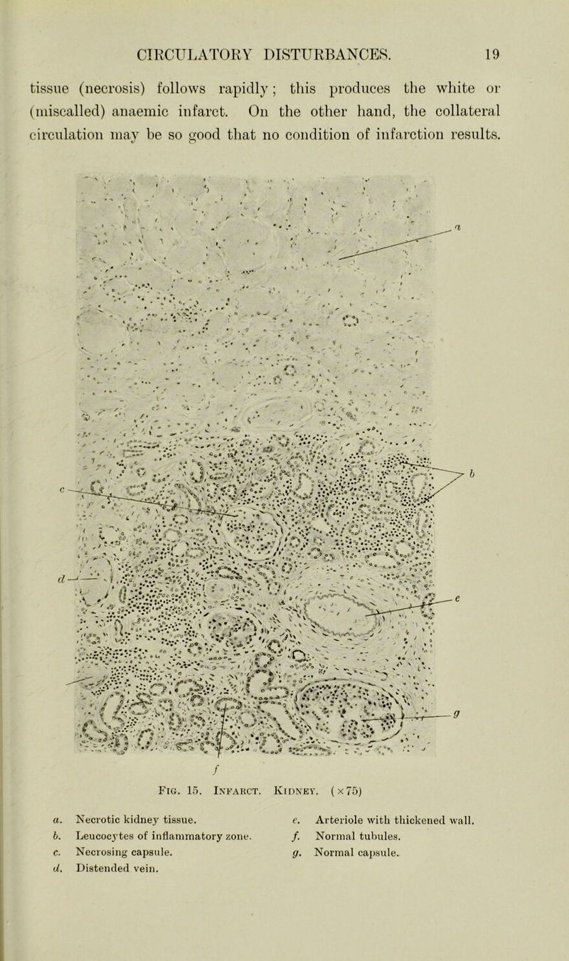 tissue (necrosis) follows rapidly; tliis produces the white or (miscalled) anaemic infarct. On the other hand, the collateral circulation may be so good that no condition of infarction results. 11 ^ t s r * w O 6 ' ■ * « O \ ^ ' • * • - -s'-' « , • ^ '* - - • - • • • . < r * ‘ \ • \ f I » o Fig. 15. Infarct. Kidney. (x75) a. Necrotic kidney tissue. b. Leucocytes of inflammatory zone. c. Necrosing capsule. d. Distended vein. e. Arteriole with thickened wall. /. Normal tubules. g. Normal capsule.