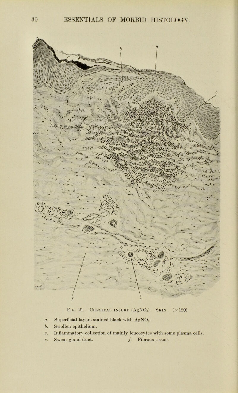 Fig. 21. Chkmical injuuv (AgNOg). Skin. (x120) a. Superficial layers stained black with AgNClj. b. Swollen epithelium. c. Inflammatory collection of mainly leucocytes with some plasma celL«. e. Sweat gland duct. /. Fibrous tissue.
