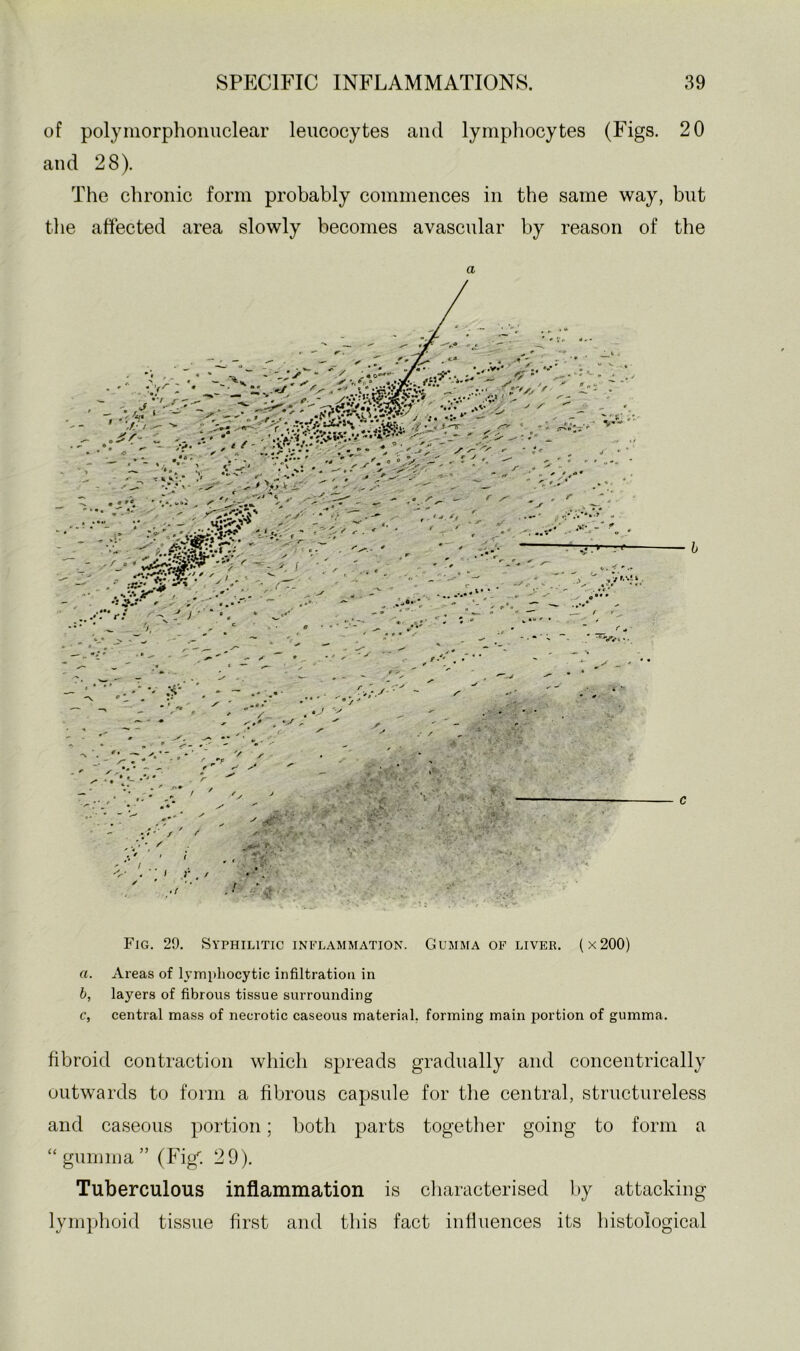 of polymorphonuclear leucocytes and lymphocytes (Figs. 20 and 28). The chronic form probably commences in the same way, but tlie affected area slowly becomes avascular by reason of the a Fig. 29. Syphilitic inflammation. Gumma of liver. (x200) a. Areas of lymphocytic infiltration in h, layers of fibrous tissue surrounding c, central mass of necrotic caseous material, forming main portion of gumma. fibroid contraction which spreads gradually and concentrically outwards to form a fibrous capsule for the central, structureless and caseous portion; both parts togetlier going to form a “gumma” (Fig''. 29). Tuberculous inflammation is cliaracterised l>y attacking lyni])hoid tissue first and this fact influences its histological