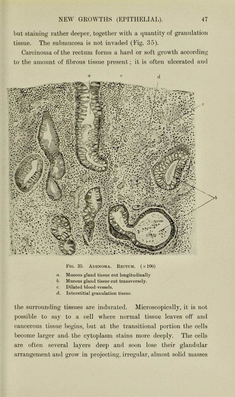 but staining rather deeper, together with a quantity of granulation tissue. The subniucosa is not invaded (Fig. 35). Carcinoma of tlie rectum forms a hard or soft growth according to tlie amount of fibrous tissue present; it is often ulcerated and a c ♦»***»! Fig. 35. Adenoma. Rectum. {x 100) a. Mucous gland tissue cut longitudinally b. Mucous gland tissue cut transversely, c. Dilated blood-vessels. d. Interstitial granulation tissue. the surrounding tissues are indurated. Microscopically, it is not possible to say to a cell where normal tissue leaves off and cancerous tissue begins, but at the transitional portion the cells become larger and- the cytoplasm stains more deeply. The cells are often several layers deep and soon lose their glandular arrangement and grow in projecting, irregular, almost solid masses