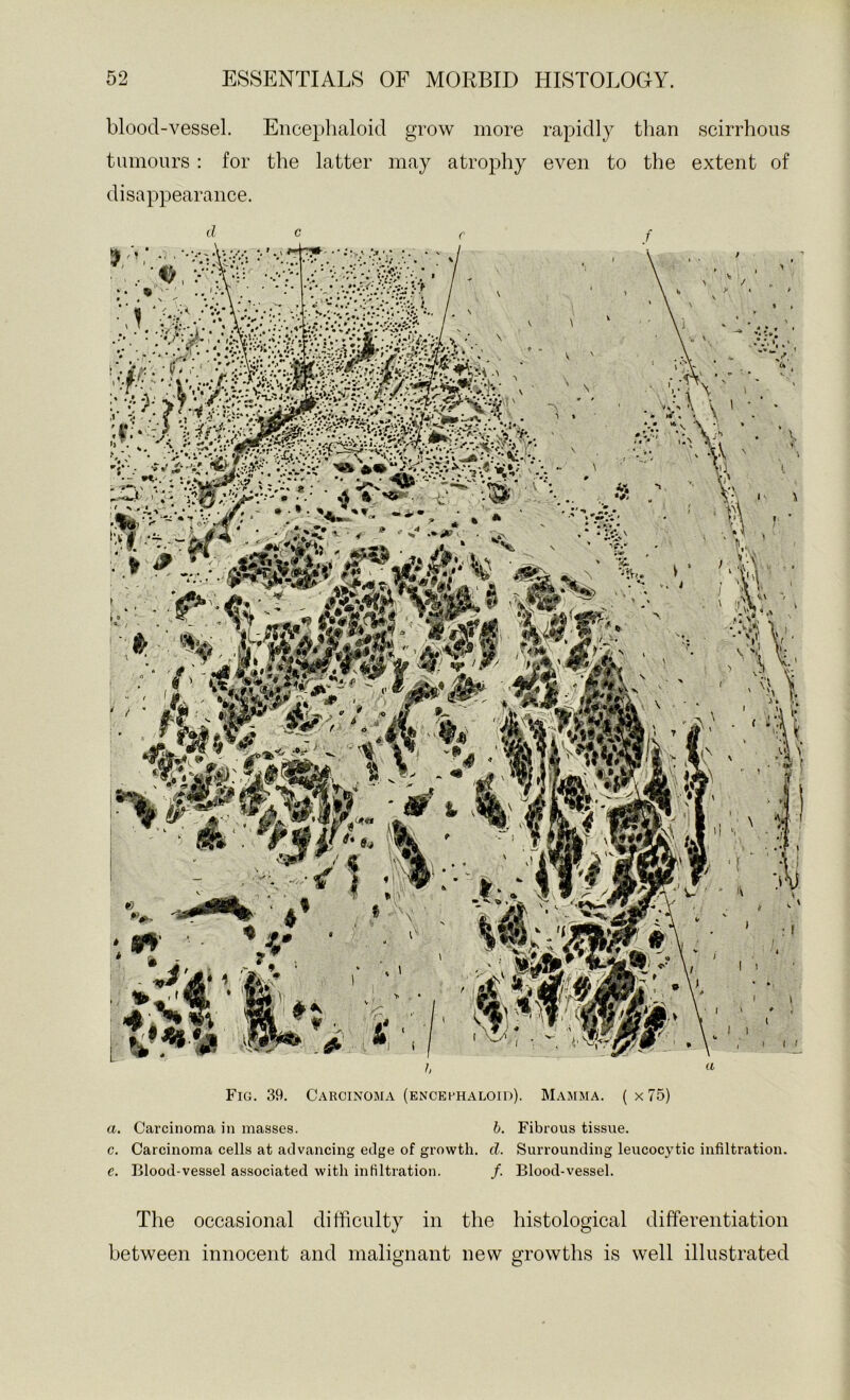 blood-vessel. Enceplialoid grow more rapidly than scirrhous tumours: for the latter may atrophy even to the extent of disappearance. h « Fig. 39. Carcinoma (encei-haloid). Mamma. ( x 75) a. Carcinoma in masses. h. Fibrous tissue. c. Carcinoma cells at advancing edge of growth, d. Surrounding leucocytic infiltration. e. Blood-vessel associated with iiiHltration. /. Blood-vessel. The occasional difficulty in the histological differentiation between innocent and malignant new growths is well illustrated