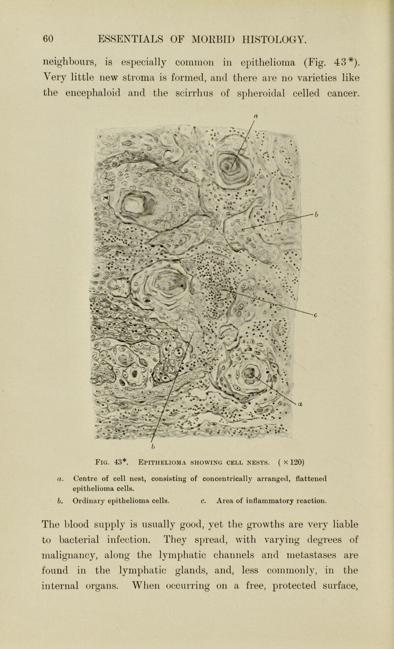 neighbours, is especially comiiion in epithelioma (Fig. 43*). Very little new stroma is formed, and there are no varieties like the encephaloid and the scirrhus of spheroidal celled cancer. a Fig. 4,3*. Epithelioma showing cell nests. ( x 120) a. Centre of cell nest, consisting of concentrically arranged, flattened epithelioma cells. b. Ordinary epithelioma cells. c. Area of inflammatory reaction. The blood supply is usually good, yet the growths are very liable to bacterial infection. They spread, with varying degrees of malignancy, along the lymphatic channels and nietastases are found in the lymphatic glands, and, less commonly, in the internal organs. When occurring on a free, protected surface.