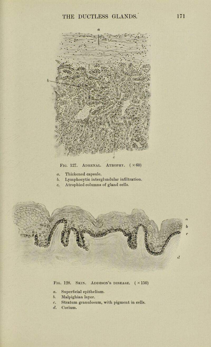 a 1 ‘ cT;«: Fig. 127. Adhenal. Atrophy. ( x 60) a. Thickened capsule. b. Lymphocytic interglnndular infiltration. c. Atrojihied columns of gland cells. P’lG. 128. Skin. Addison’s disease. ( x 150) a. Superficial epithelium. b. ]\Ialpighian layer. c. Stratum granulosum, with pigment in cells. d. Corium.