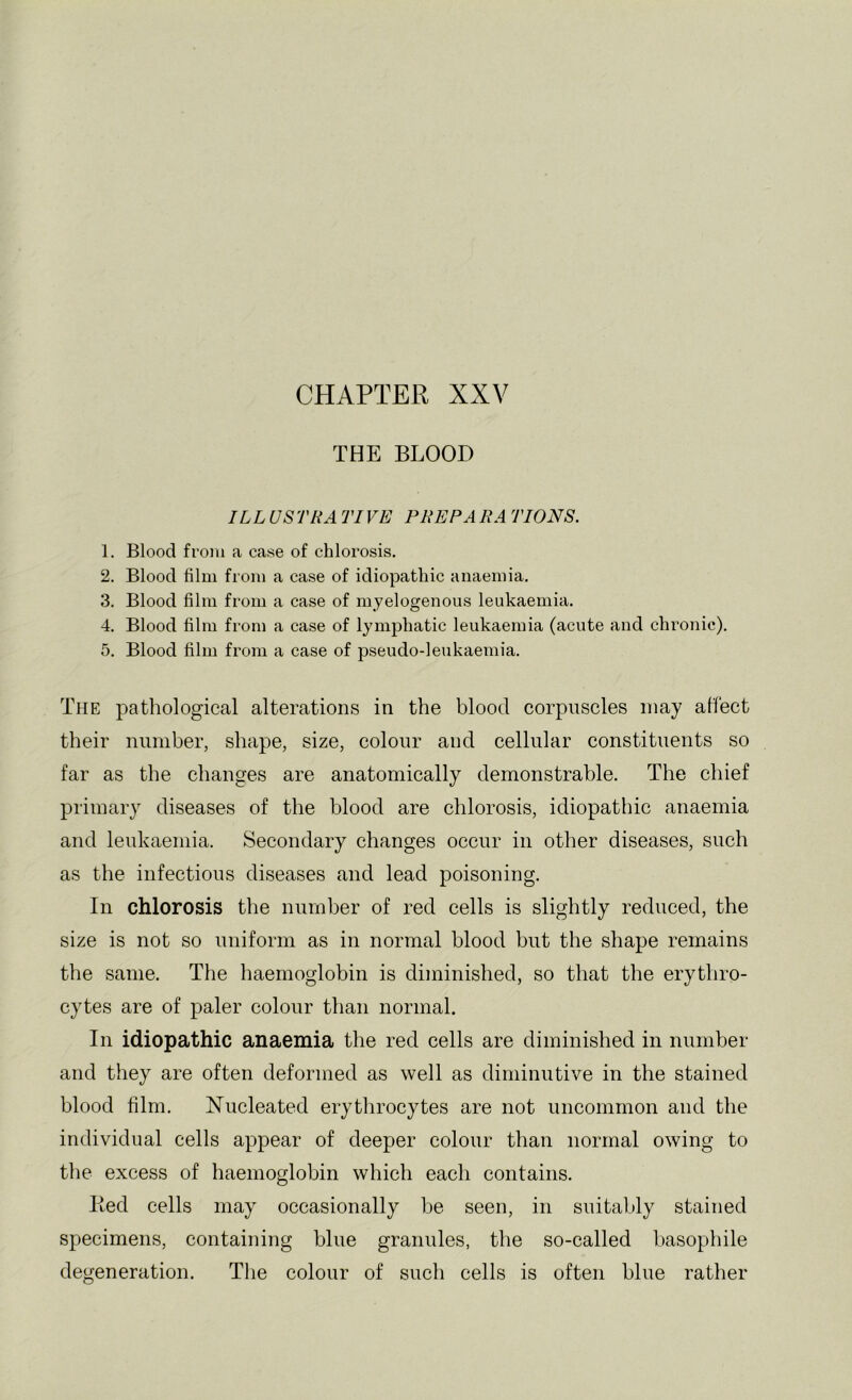 THE BLOOD ILL US TRA TIVE PREP A RA TIONS. 1. Blood from a case of chlorosis. 2. Blood film from a case of idiopathic anaemia. 3. Blood film from a case of myelogenous leukaemia. 4. Blood film from a case of lymphatic leukaemia (acute and chronic). 5. Blood film from a case of pseudo-leukaemia. The pathological alterations in the blood corpuscles may affect their number, shape, size, colour and cellular constituents so far as the changes are anatomically demonstrable. The chief primary diseases of the blood are chlorosis, idiopathic anaemia and leukaemia. Secondary changes oceur in other diseases, such as the infectious diseases and lead poisoning. In chlorosis the number of red cells is slightly reduced, the size is not so uniform as in normal blood but the shape remains the same. The haemoglobin is diminished, so that the erythro- cytes are of paler colour than normal. In idiopathic anaemia the red cells are diminished in number and they are often deformed as well as diminutive in the stained blood film. Nucleated erythrocytes are not uncommon and the individual cells appear of deeper colour than normal owing to the excess of haemoglobin which each contains. Red cells may occasionally be seen, in suitably stained specimens, containing blue granules, the so-called basophile degeneration. The colour of such cells is often blue rather