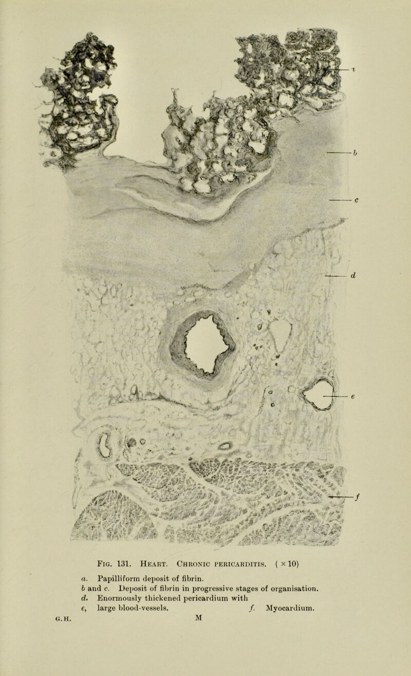 Fig. 131. Heart. Chronic pericarditis. { x 10) a. Papilliform deposit of fibrin. b and c. Deposit of fibrin in progressive stages of organisation. d. Enormously thickened pericardium with e, large blood-vessels. /. Myocardium. G.H M