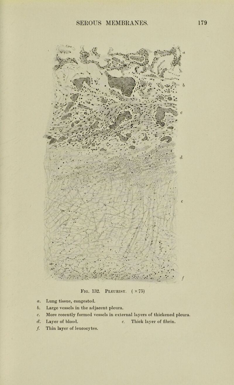 Fig. 132. Pleurisy. ( x 75) a. Lung tissue, congested. b. Large vessels in the adjacent pleura. c. More recentlj' formed vessels in external layers of thickened pleura. d. Layer of blooil. e. Thick layer of fibrin. /. Thin layer of leucocytes.