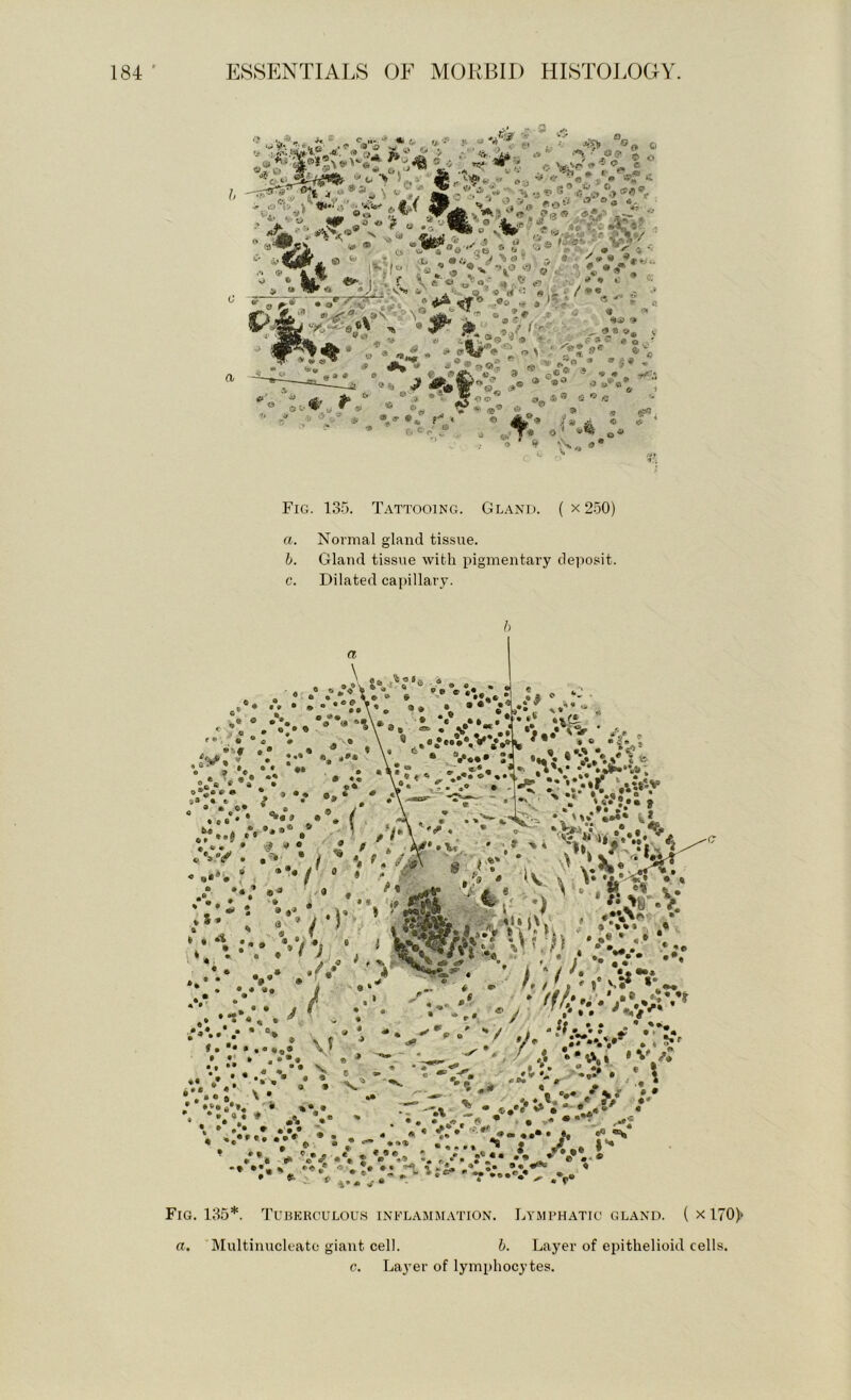 V•‘t? .<> i: a oi-^o»s> ® © \r«iw' ’ ‘ ^ cAvj* * t ,■3 ® 4’’* I ,•> T« (9 ’ Fig. 135. Tattooing. Gland. ( x 250) a. Normal gland tissue. h. Gland tissue with pigmentary deposit. c. Dilated capillary. a 9 ■'* *B*©^*.* : • • *1 A* » » »?•» t Fig. 135*. Tujbkkculou.s inflammation. Lymphatic gland. (xl70)* a. IMultinucleato giant cell. b. Layer of epithelioid cells. c. La3'er of lymphocytes.