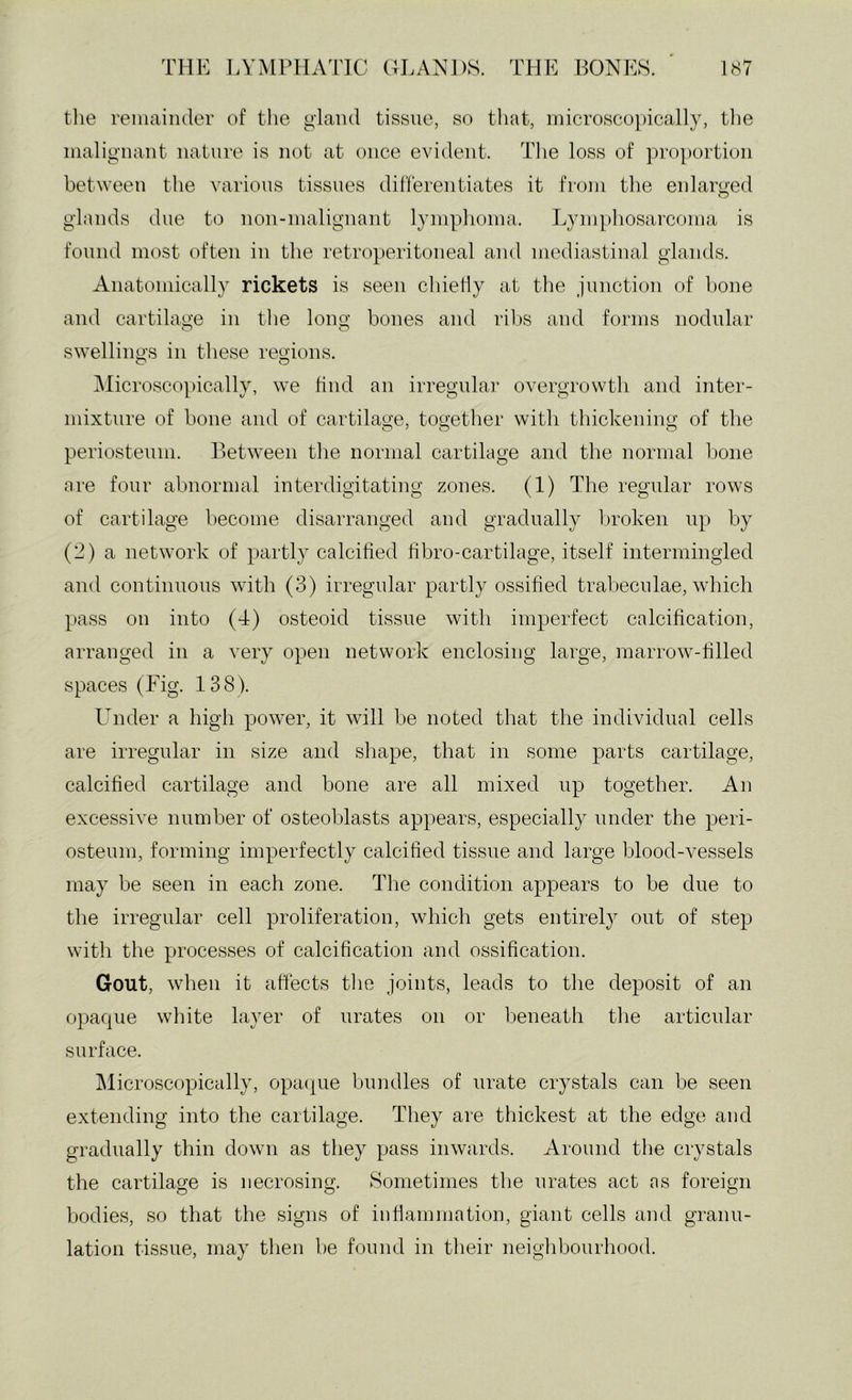 the reniaiiuler of the g'laiul tissue, so that, microsco})ically, tlie iiialignant nature is not at once evident. The loss of pro])ortion between tlie various tissues diherentiates it from the enlarged glands due to non-iualignant lymphoma. Lymphosarcoma is found most often in the retroperitoneal and mediastinal glands. Anatomically rickets is seen cliieliy at the junction of hone and cartilage in tlie long bones and ribs and forms nodular swellings in these regions. O O IMicroscopically, we find an irregular overgrowth and inter- mixture of bone and of cartilage, together with thickening of the periosteum. Between the normal cartilage and the normal bone are four abnormal interdigitating zones. (1) The regular rows of cartilage become disarranged and gradually broken up by (2) a network of partly calcified hbro-cartilage, itself intermingled and continuous with (3) irregular partly ossified tralieculae, which pass on into (4) osteoid tissue with imperfect calcification, arranged in a very open network enclosing large, marrow-filled spaces (Fig. 138). Under a high power, it will be noted that the individual cells are irregular in size and shape, that in some parts cartilage, calcified cartilage and bone are all mixed up together. An excessive number of osteoblasts appears, especially under the peri- osteum, forming imperfectly calcified tissue and large blood-vessels may be seen in each zone. Tlie condition appears to be due to the irregular cell proliferation, which gets entirel}^ out of step with the processes of calcification and ossification. Gout, when it affects tlie joints, leads to the deposit of an opaque white layer of urates on or beneath tlie articular surface. Microscopically, opacjue bundles of urate crystals can be seen extending into the cartilage. They are thickest at the edge and gradually thin down as they pass inwards. Around the crystals the cartilage is necrosing. Sometimes the urates act as foreign bodies, so that the signs of inflammation, giant cells and granu- lation tissue, may then be found in their neighbourhood.