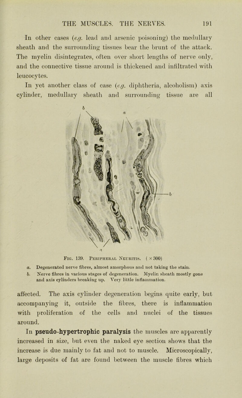 111 other cases {e.g. lead and arsenic poisoning) the mednllary sheath and the siirroniidino- tissues hear the l)rnnt of the attack. The myelin disintegrates, often over short lengths of nerve only, and the connective tissue around is thickened and intiltrated with leucocytes. Ill yet another class of case {e.g. diphtheria, alcoholism) axis cylinder, mednllary sheath and snrronnding tissue are all h n Fig. 139. Peiupher.al Neuritis. ( x300) a. Degenerated nerve fibres, almost amorphous and not taking the stain. b. Nerve fibres in various stages of degeneration. Myelin sheath mostly gone and axis cylinders breaking up. Very little inflammation. affected. The axis cylinder degeneration begins quite early, but accompanying it, outside the fibres, there is inflammation with proliferation of the cells and nuclei of the tissues around. In pseudo-hypertrophic paralysis the muscles are apparently increased in size, l)ut even the naked eye section shows that the increase is due mainly to fat and not to muscle. Microscopically, large deposits of fat are found between the muscle fibres which