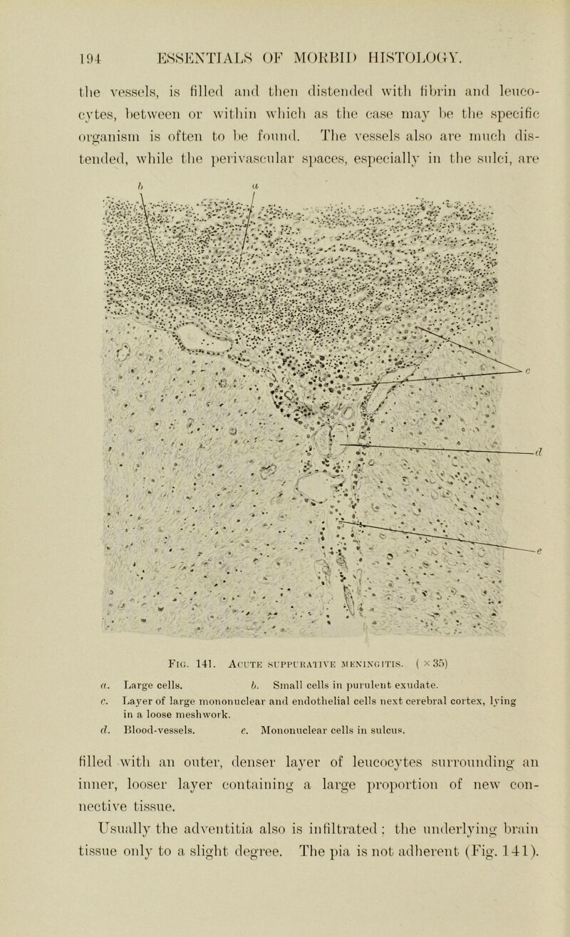 the vessels, is filled and then distended with fibrin and leuco- cytes, between or within which as the case may he the specific organism is often tended, while the to he found. The vessels also are much dis- perivascular s}>aces, especially in the sulci, are Fra. 141. Acuxr: suppuhative jiemxgitis. ( x 35) a. Large cells. b. Small cells in purulent exudate. c. Layer of large mononuclear and endothelial cells next cerebi’al cortex, lying in a loose meshwork. d. Blood-vessels. c. IMononuclear cells in sulcus. filled with an outer, denser inner, looser layer contain in nective tissue. Usually the adventitia also tissue only to a slight degree. layer of leucocytes surroundino- an V V O g a large proportion of new con- is infiltrated ; the underlying brain The pia is not adherent (Fig. 141).