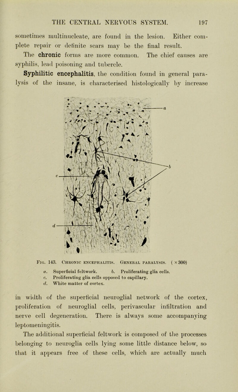 sometimes miiltiiiucleate, are found in tlie lesion. Either com- plete re})oir or definite scars may be the final residt. The chronic forms are more common. The chief causes are syphilis, lead poisoning and tul)ercle. Syphilitic encephalitis, the condition found in general para- lysis of tlie insane, is characterised histologically by increase Fig. 143. Chronic encephalitis. General paralysis. ( x 300) a. Superficial feltwork. b. Proliferating glia cells. c. Proliferating glia cells opposed to capillary. d. White matter of corte.K. ill width of the superficial neuroglial network of the cortex, proliferation of neuroglial cells, perivascular infiltration and nerve cell degeneration. Tliere is always some accompanying leptomeningitis. The additional superficial feltwork is composed of the processes belonging to neuroglia cells lying some little distance below, so tliat it appears free of these cells, which are actually much