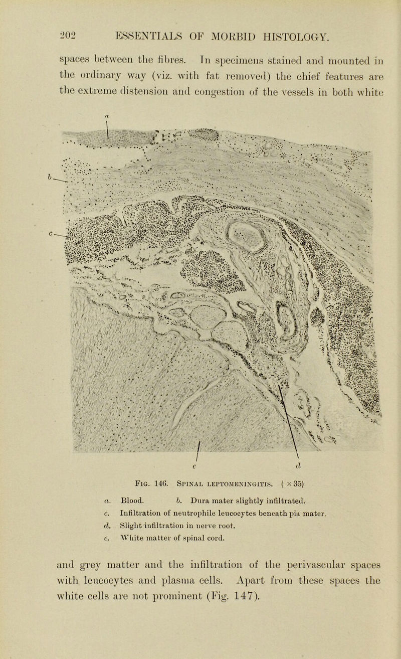 spaces l)etweeii tlie fibres. In speciineiis stained and inoniited in tlie ordinary way (viz. with fat removed) the chief features are the extreme distension and congestion of the vessels in botli wliite n. c d Fig. 14G. Spinal leptomeningiti.s. ( x 35) a. Blood. h. Dura mater slightly infiltrated. c. Infiltration of neutrophile leucocytes beneath pia mater. d. Slight infiltration in nerve root. c. White matter of spinal cord. and grey matter and the infiltration of the perivascnlar spaces with leucocytes and plasma cells. Apart from these spaces the white cells are not prominent (Fig. 147).