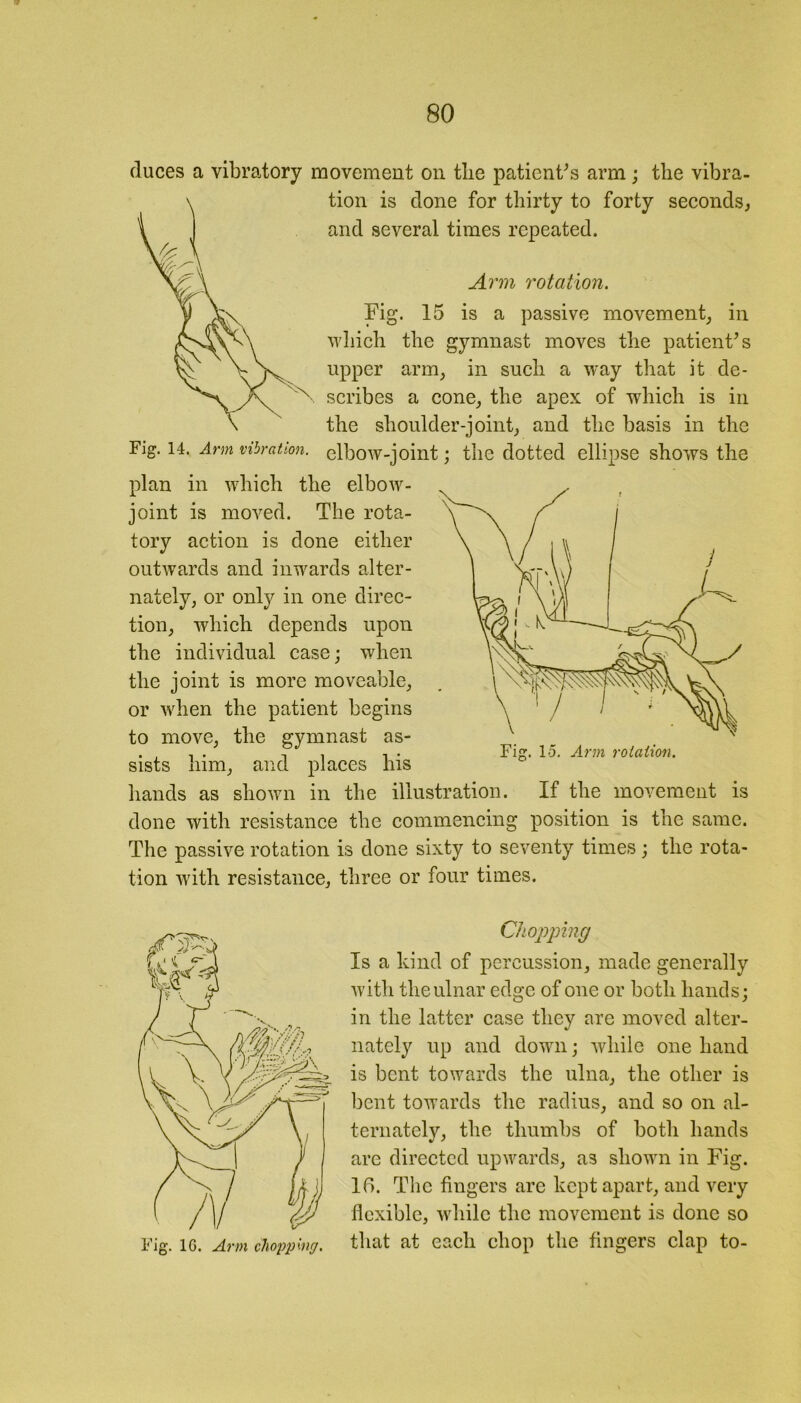 duces a vibratory movement on tlie patient's arm; the vibra- tion is done for thirty to forty seconds, and several times repeated. Arm rotation. Fig. 15 is a passive movement, in which the gymnast moves the patient's upper arm, in such a way that it de- scribes a cone, the apex of which is in the shoulder-joint, and the basis in the Fjg. 14. Arm vibration, elbow-joint; the dotted ellipse shows the plan in which the elbow- joint is moved. The rota- tory action is done either outwards and inwards alter- nately, or only in one direc- upon the individual case; when the joint is more moveable, or when the patient begins to move, the gymnast as- . , , . i . Fig. 1-5. Arm rotation. sists him, and places his hands as shown in the illustration. If the movement is done with resistance the commencing position is the same. The passive rotation is done sixty to seventy times ; the rota- tion with resistance, three or four times. tion, which depends Chopping Is a kind of percussion, made generally with theulnar edge of one or both hands; in the latter case they are moved alter- nately up and down; while one hand is bent towards the ulna, the other is bent towards the radius, and so on al- ternately, the thumbs of both hands are directed upwards, as shown in Fig. Id. The fingers are kept apart, and very flexible, while the movement is done so that at each chop the fingers clap to-