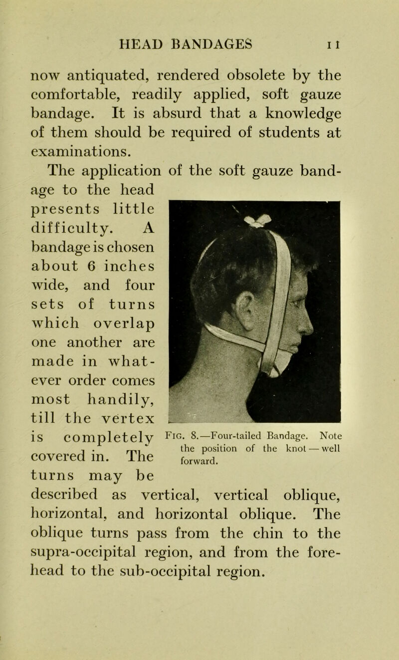 now antiquated, rendered obsolete by the comfortable, readily applied, soft gauze bandage. It is absurd that a knowledge of them should be required of students at examinations. The application of the soft gauze band- age to the head presents little difficulty. A bandage is chosen about 6 inches wide, and four sets of turns which overlap one another are made in what- ever order comes most handily, till the vertex is completely covered in. The turns may be described as vertical, vertical oblique, horizontal, and horizontal oblique. The oblique turns pass from the chin to the supra-occipital region, and from the fore- head to the sub-occipital region. Fig. 8.—Four-tailed Bandage. Note the position of the knot — well forward.