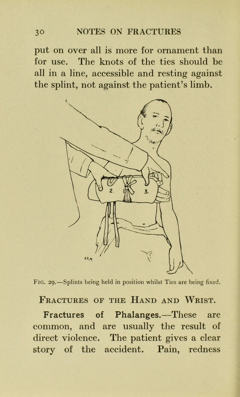 put on over all is more for ornament than for use. The knots of the ties should be all in a line, accessible and resting against the splint, not against the patient’s limb. Fig. 29.—Splints being held in position whilst Ties are being fixed. Fractures of the Hand and Wrist. Fractures of Phalanges.—These are common, and are usually the result of direct violence. The patient gives a clear story of the accident. Pain, redness