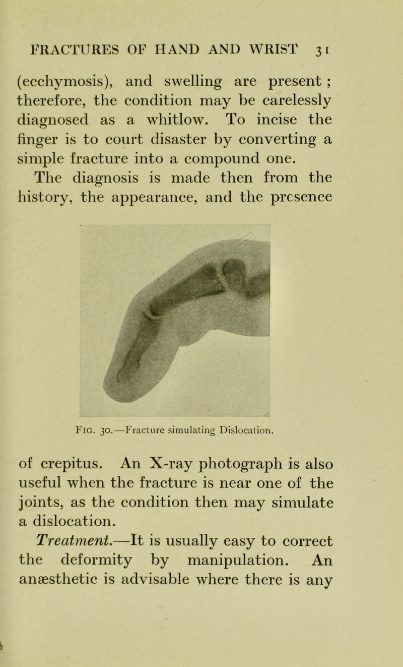 (ecchymosis), and swelling are present ; therefore, the condition may be carelessly diagnosed as a whitlow. To incise the finger is to court disaster by converting a simple fracture into a compound one. The diagnosis is made then from the history, the appearance, and the presence of crepitus. An X-ray photograph is also useful when the fracture is near one of the joints, as the condition then may simulate a dislocation. Treatment.—It is usually easy to correct the deformity by manipulation. An anaesthetic is advisable where there is any
