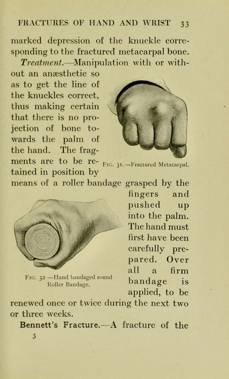 Fig. 31.—Fractured Metacarpal. marked depression of the knuckle corre- sponding to the fractured metacarpal bone. Treatment.—Manipulation with or with- out an anaesthetic so as to get the line of the knuckles correct, thus making certain that there is no pro- jection of bone to- wards the palm of the hand. The frag- ments are to be re- tained in position by means of a roller bandage grasped by the fingers and pushed up into the palm. The hand must first have been carefully pre- pared. Over all a firm bandage is applied, to be renewed once or twice during the next two or three weeks. Bennett’s Fracture.—A fracture of the Fig. 32 —Hand bandaged round Roller Bandage. 3