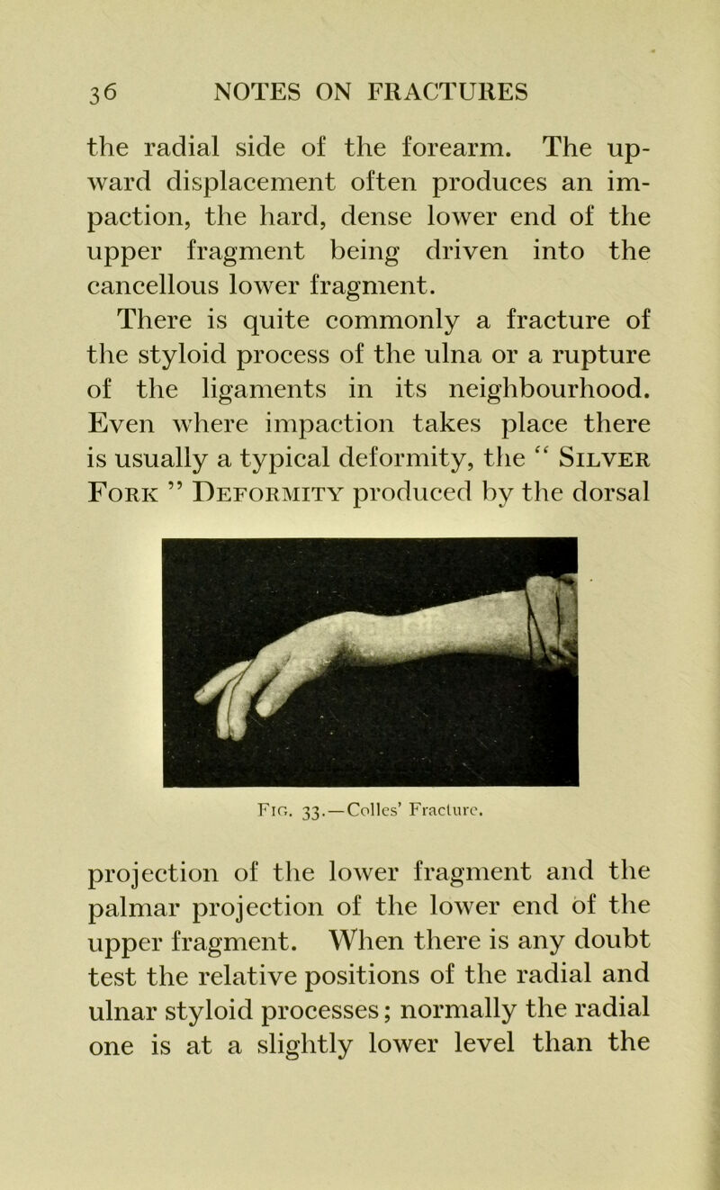 the radial side of the forearm. The up- ward displacement often produces an im- paction, the hard, dense lower end of the upper fragment being driven into the cancellous lower fragment. There is quite commonly a fracture of the styloid process of the ulna or a rupture of the ligaments in its neighbourhood. Even where impaction takes place there is usually a typical deformity, the “ Silver Fork ” Deformity produced by the dorsal projection of the lower fragment and the palmar projection of the lower end of the upper fragment. When there is any doubt test the relative positions of the radial and ulnar styloid processes; normally the radial one is at a slightly lower level than the