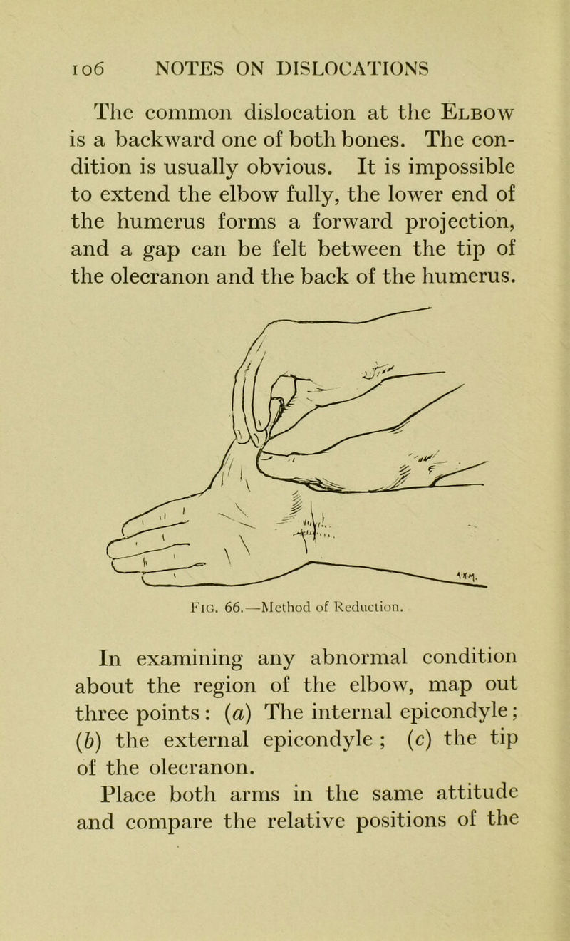 The common dislocation at the Elbow is a backward one of both bones. The con- dition is usually obvious. It is impossible to extend the elbow fully, the lower end of the humerus forms a forward projection, and a gap can be felt between the tip of the olecranon and the back of the humerus. In examining any abnormal condition about the region of the elbow, map out three points : (a) The internal epicondyle; (b) the external epicondyle ; (c) the tip of the olecranon. Place both arms in the same attitude and compare the relative positions of the