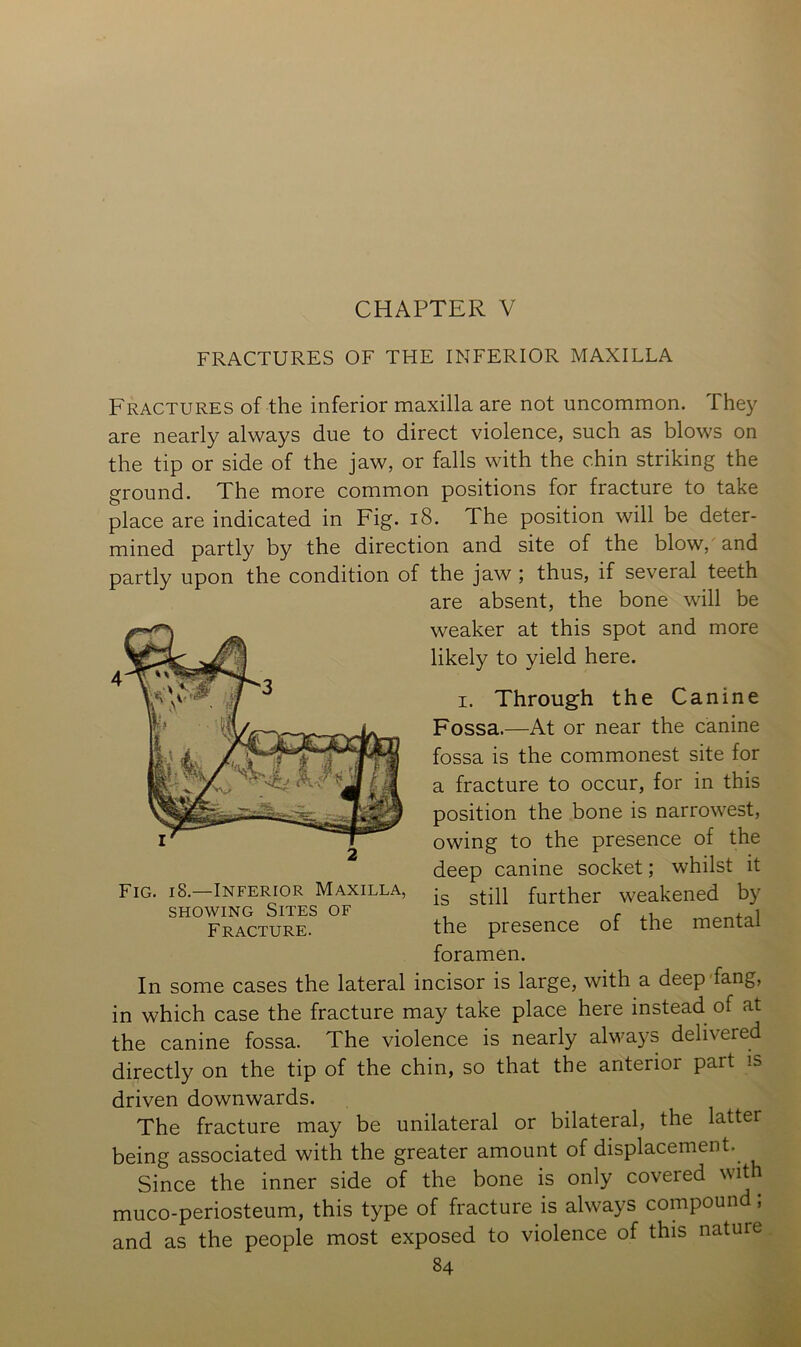 CHAPTER V FRACTURES OF THE INFERIOR MAXILLA Fractures of the inferior maxilla are not uncommon, fhe}^ are nearly always due to direct violence, such as blows on the tip or side of the jaw, or falls with the chin striking the ground. The more common positions for fracture to take place are indicated in Fig. i8. The position will be deter- mined partly by the direction and site of the blow, and partly upon the condition of the jaw; thus, if several teeth are absent, the bone will be weaker at this spot and more likely to yield here. I. Through the Canine Fossa.—At or near the canine fossa is the commonest site for a fracture to occur, for in this position the bone is narrowest, owing to the presence of the deep canine socket; whilst it is still further weakened by the presence of the mental Fig. i8.—Inferior Maxilla, SHOWING Sites of Fracture. foramen. In some cases the lateral incisor is large, with a deep fang, in which case the fracture may take place here instead of at the canine fossa. The violence is nearly always delivered directly on the tip of the chin, so that the anterior part is driven downwards. The fracture may be unilateral or bilateral, the latter being associated with the greater amount of displacement. Since the inner side of the bone is only covered with muco-periosteum, this type of fracture is always compound; and as the people most exposed to violence of this nature