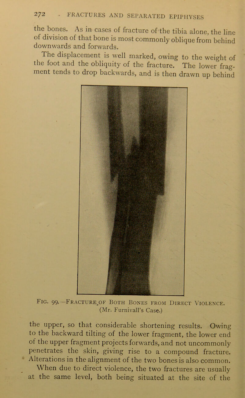 the bones. As in cases of fracture of the tibia alone, the line of division of that bone is most commonly oblique from behind downwards and forwards. The displacement is well marked, owing to the weight of the foot and the obliquity of the fracture. The lower frag- ment tends to drop backwards, and is then drawn up behind Fig. 99.—Fracture_of Both Bones from Direct Violence. (Mr. Furnivall’s Case.) the upper, so that considerable shortening results. Owing to the backward tilting of the lower fragment, the lower end of the upper fragment projects forwards, and not uncommonly penetrates the skin, giving rise to a compound fracture. Alterations in the alignment of the two bones is also common. When due to direct violence, the two fractures are usually at the same level, both being situated at the site of the