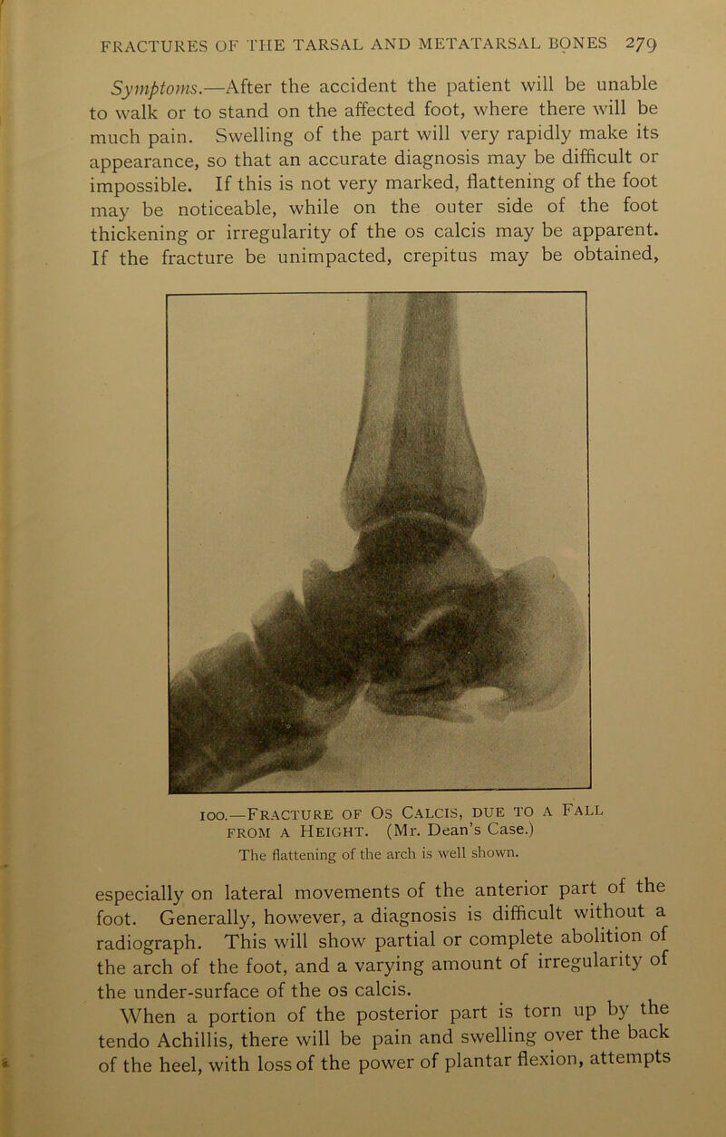 Symptoms.—After the accident the patient will be unable to walk or to stand on the affected foot, where there will be much pain. Swelling of the part will very rapidly make its appearance, so that an accurate diagnosis may be difficult or impossible. If this is not very marked, flattening of the foot may be noticeable, while on the outer side of the foot thickening or irregularity of the os calcis may be apparent. If the fracture be unimpacted, crepitus may be obtained. 100.—Fracture of Os Calcis, due to a Fall FROM A Height. (Mr. Dean’s Case.) The flattening of the arch is well shown. especially on lateral movements of the anterior part of the foot. Generally, however, a diagnosis is difficult without a radiograph. This will show partial or complete abolition of the arch of the foot, and a varying amount of irregularity of the under-surface of the os calcis. When a portion of the posterior part is torn up by the tendo Achillis, there will be pain and swelling over the back of the heel, with loss of the power of plantar flexion, attempts