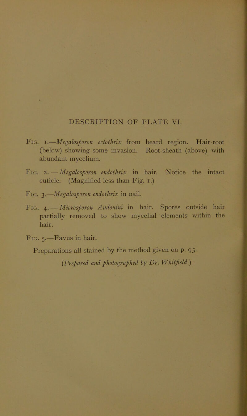 Fig, I.—Megalosporon ectothrix from beard region. Hair-root (below) showing some invasion. Root-sheath (above) with abundant mycelium. Fig. 2. — Megalosporon endothrix in hair. Notice the intact cuticle. (Magnified less than Fig. i.) Fig. 3.—Megalosporon endothrix in nail. Fig. 4. — Microsporon Andouini in hair. Spores outside hair partially removed to show mycelial elements within the hair. Fig. 5.—Favus in hair. Preparations all stained by the method given on p. 95. {Prepared and photographed by Dr. Whitfield.)
