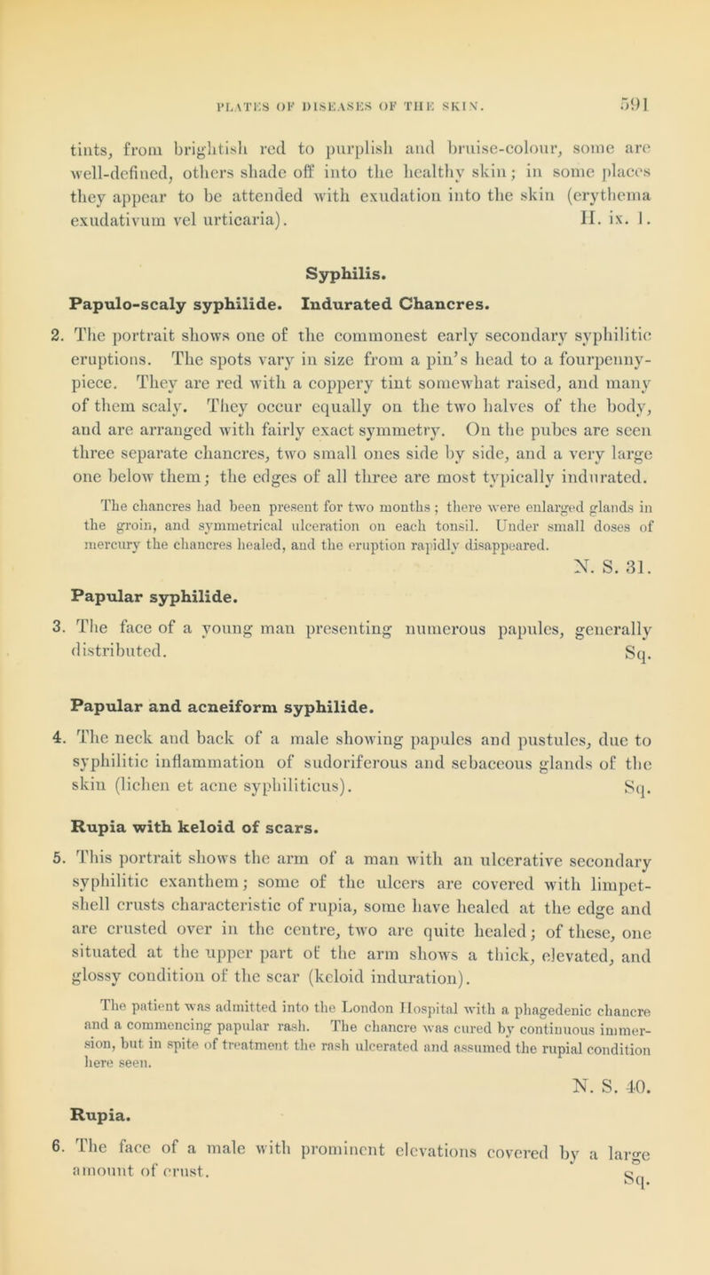 tints, from brightish red to purplish and bruise-colour, some are well-defined, others shade off into the healthy skin; in some places they appear to be attended with exudation into the skin (erythema exudativum vel urticaria). II. ix. 1. Syphilis. Papulo-scaly syphilide. Indurated Chancres. 2. The portrait shows one of the commonest early secondary syphilitic eruptions. The spots vary in size from a pin’s head to a fourpenny- piece. They are red with a coppery tint somewhat raised, and many of them scaly. They occur equally on the two halves of the body, and are arranged with fairly exact symmetry. On the pubes are seen three separate chancres, two small ones side by side, and a very large one below them; the edges of all three are most typically indurated. The chancres had been present for two months ; there were enlarged glands in the groin, and symmetrical ulceration on each tonsil. Under small doses of mercury the chancres healed, and the eruption rapidly disappeared. N. S. 31. Papular syphilide. 3. The face of a young man presenting numerous papules, generally distributed. Sq. Papular and acneiform syphilide. 4. The neck and back of a male showing papules and pustules, due to syphilitic inflammation of sudoriferous and sebaceous glands of the skin (lichen et acne syphiliticus). Sq. Rupia with keloid of scars. 5. This portrait shows the arm of a man with an ulcerative secondary syphilitic exanthem; some of the ulcers are covered with limpet- shell crusts characteristic of rupia, some have healed at the edge and are crusted over in the centre, two are quite healed; of these, one situated at the upper part of the arm shows a thick, elevated, and glossy condition of the scar (keloid induration). The patieut was admitted into the London Hospital with a phagedenic chancre and a commencing papular rash. The chancre was cured by continuous immer- sion, but in spite of treatment the rash ulcerated and assumed the rupial condition here seen. N. S. 40. Rupia. 6. The face of a male with prominent elevations covered by a large amount of crust. c- OCJ.