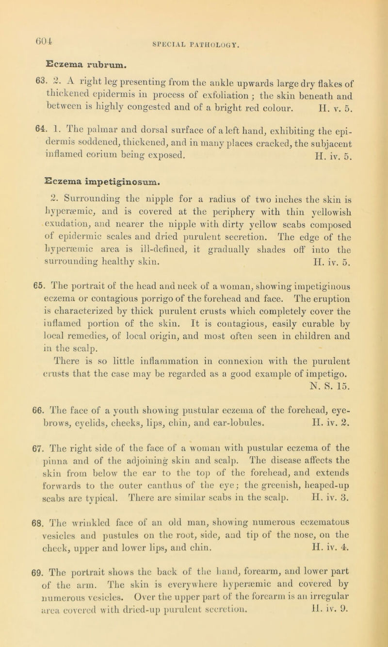 60 1 Eczema rub rum. 63. 2. A right leg presenting from the ankle upwards large dry flakes of thickened epidermis in process of exfoliation ; the skin beneath and between is highly congested and of a bright red colour. H. v. 5. 61. 1. The palmar and dorsal surface of a left hand, exhibiting the epi- dermis soddened, thickened, and in many places cracked, the subjacent inflamed corium being exposed. H. iv. 5. Eczema impetiginosum. 2. Surrounding the nipple for a radius of two inches the skin is hyperaemic, and is covered at the periphery with thin yellowish exudation, and nearer the nipple with dirty yellow scabs composed of epidermic scales and dried purulent secretion. The edge of the hypersemic area is ill-defined, it gradually shades oft' into the surrounding healthy skin. II. iv. 5. 65. The portrait of the head and neck of a woman, showing impetiginous eczema or contagious porrigo of the forehead and face. The eruption is characterized by thick purulent crusts which completely cover the inflamed portion of the skin. It is contagious, easily curable by local remedies, of local origin, and most often seen in children and in the scalp. There is so little inflammation in connexion with the purulent crusts that the case may be regarded as a good example of impetigo. N. S. 15. 66. The face of a youth showing pustular eczema of the forehead, eye- brows, eyelids, cheeks, lips, chin, and ear-lobules. II. iv. 2. 67. The right side of the face of a woman with pustular eczema of the pinna and of the adjoining skin and seal]). The disease affects the skin from below the ear to the top of the forehead, and extends fonvards to the outer canthus of the eye; the greenish, heaped-up scabs are typical. There are similar scabs in the scalp. PI, iv. 3. 68. The wrinkled face of an old man, showing numerous eczematous vesicles and pustules on the root, side, and tip of the nose, on the check, upper and lower lips, and chin. II. iv. 4. 69. The portrait shows the back of the hand, forearm, and lower part of the arm. The skin is everywhere hypenemic and covered by numerous vesicles. Over the upper part of the forearm is an irregular