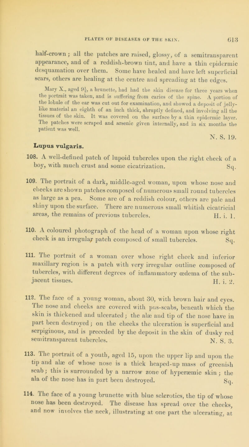 half-crown; all the patches are raised, glossy, of a semitransparent appearance, and of a reddish-brown tint, and have a thin epidermic desquamation over them. Some have healed and have left superficial scars, others are healing at the centre and spreading at the edges. Mary X., aged 9|, a brunette, bad had the skin disease for three years when the portrait was taken, and is suffering from caries of the spine. A portion of the lobule of the ear was cut out for examination, and showed a deposit of jelly- like material an eighth ol an inch thick, abruptly defined, and involving all the tissues of the skin. It was covered ou the surface by a thin epidermic layer. The patches were scraped and arsenic given internally, and in six months the patient was well. N. S. 19. Lupus vulgaris. 108. A well-defined patch of lupoid tubercles upon the right cheek of a boy, with much crust and some cicatrization. Sq. 109. The portrait of a dark, middle-aged woman, upon whose nose and cheeks are shown patches composed of numerous small round tubercles as large as a pea. Some are of a reddish colour, others are pale and shiny upon the surface. There are numerous small whitish cicatricial areas, the remains of previous tubercles. II. i. 1. 110. A coloured photograph of the head of a woman upon whose right cheek is an irregulap patch composed of small tubercles. Sq. 111. The portrait of a woman over whose right cheek and inferior maxillary region is a patch with very irregular outline composed of tubercles, with different degrees of inflammatory oedema of the sub- jacent tissues. II j o. 112. The face of a young woman, about 30, with brown hair and eyes. I he nose and cheeks are covered with pus-scabs, beneath which the skin is thickened and ulcerated; the alae and tip of the nose have in part been destroyed; on the cheeks the ulceration is superficial and serpiginous, and is preceded by the deposit in the skin of dusky red semitransparent tubercles. N. S. 3. 113. 1 he portrait of a youth, aged 15, upon the upper lip and upon the tip and alae of whose nose is a thick lieaped-up mass of greenish scab; this is surrounded by a narrow zone of liyperaemic skin; the ala of the nose has in part been destroyed. Sq. 114. The face of a young brunette with blue sclerotics, the tip of whose nose has been destroyed. The disease has spread over the cheeks, and now involves the neck, illustrating at one part the ulcerating, at