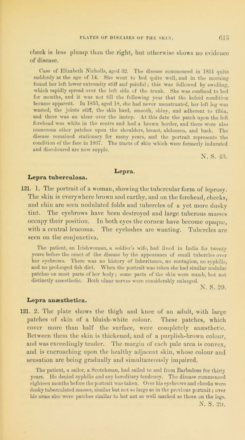 clieek is less plump than the right, but otherwise shows no evidence of disease. Case of Elizabeth Nicholls, aged 32. The disease commenced in 1851 quite suddenly at the age of 14. She went to bed quite well, and in the morning found her left lower extremity stiff and painful; this was followed by swelling, which rapidly spread over the left side of the trunk. She was confined to bed for months, and it was not till the following year that the keloid condition became apparent. In 1855, aged 18, she had never menstruated, her left leg was wasted, the joints stiff, the skin hard, smooth, shiny, and adherent to tibia, and there was an ulcer over the instep. At this date the patch upon the left forehead was white in the centre and had a brown border, and there were also numerous other patches upon the shoulders, breast, abdomen, and back. The disease remained stationary for many years, and the portrait represents the condition of the face in 18G7. The tracts of skin which were formerly indurated and discoloured are now supple. N. S. 43. Lepra. Lepra tuberculosa. 121. 1. The portrait of a woman, showing the tubercular form of leprosy. The skin is everywhere brown and earthy, and on the forehead, cheeks, and chin are seen nodulated folds and tubercles of a yet more duskv V J tint. The eyebrows have been destroyed and large tuberous masses occupy their position. In both eyes the cornea? have become opaque, with a central leucoma. The eyelashes arc wanting. Tubercles are seen on the conjunctiva. The patient, an Irishwoman, a soldier’s wife, had lived in India for twenty years before the onset of the disease by the appearance of small tubercles over her eyebrows. There was no history of inheritance, no contagion, no syphilis, and no prolonged fish diet. When the portrait was taken she had similar nodular patches on most parts of her body; some parts of the skin were numb, but not distinctly anaesthetic. Both ulnar nerves were considerably enlarged. N. S. 29. Lepra anaesthetica. 121. 2. The plate shows the thigh and knee of an adult, with large patches of skin of a bluish-white colour. These patches, which cover more than half the surface, were completely anaesthetic. Between them the skin is thickened, and of a purplish-brown colour, and was exceedingly tender. The margin of each pale area is convex, and is encroaching upon the healthy adjacent skin, whose colour and sensation are being gradually and simultaneously impaired. The patient, a sailor, a Scotchman, had sailed to and from Barbadoes for thirty years. lie denied syphilis and any hereditary tendency. The disease commenced eighteen months before the portrait was taken. Over his eyebrows and cheeks were dusky tuberculated masses, similar but not so large as in the previous portrait; over his arms also were patches similar to but not so well marked as those on the lee's. N. S. 29.