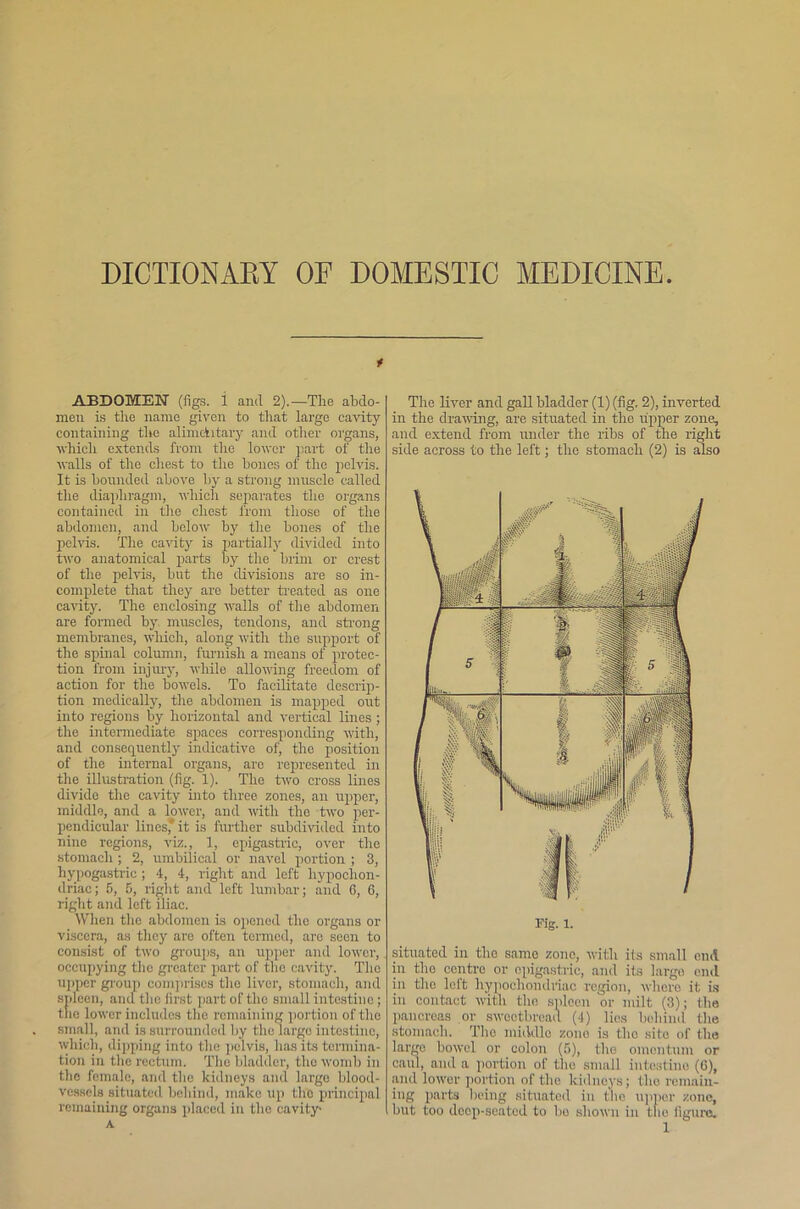 DICTION ABY OF DOMESTIC MEDICINE t ABDOMEN (figs. 1 and 2).—The abdo- men is the name given to that largo cavity containing the alimciitary and other organs, which extends from the lower part of the walls of the chest to the bones of the pelvis. It is bounded above by a strong muscle called the diaphragm, which separates the organs contained in the chest from those of the abdomen, and below by the bones of the pelvis. The cavity is partially divided into two anatomical parts by the brim or crest of the pelvis, but the divisions are so in- complete that they are better treated as one cavity. The enclosing walls of the abdomen are formed by muscles, tendons, and strong membranes, which, along with the support of the spinal column, furnish a means of protec- tion from injury, while allowing freedom of action for the bowels. To facilitate descrip- tion medically, the abdomen is mapped out into regions by horizontal and vertical lines ; the intermediate spaces corresponding with, and consequently indicative of, the position of the internal organs, are represented in the illustration (fig. 1). Tho two cross lines divide the cavity into three zones, an upper, middle, and a lower, and with tho two per- pendicular lines* it is further subdivided into nine regions, viz., 1, epigastric, over the stomach ; 2, umbilical or navel portion ; 3, hypogastric ; 4, 4, right and left hypochon- driac; 5, 5, right and loft lumbar; and 6, 6, right and left iliac. When the abdomen is opened the organs or viscera, as they are often termed, are seen to consist of two groups, an upper and lower, occupying the greater part of tho cavity. Tho upper group comprises the liver, stomach, and spleen, and the first part of the small intestine ; the lower includes the remaining portion of the small, and is surrounded by the large intestine, which, dipping into the pelvis, has its termina- tion in the rectum. The bladder, tho womb in the female, and the kidneys and large blood- vessels situated behind, make up the principal remaining organs placed in the cavity- A The liver and gall bladder (1) (fig. 2), inverted in the drawing, are situated in the upper zone, and extend from under the ribs of the right side across to the left; the stomach (2) is also situated in the same zone, with its small end in the centre or epigastric, and its largo end in tho left hypochondriac region, whore it is in contact with tho spleen or milt (3); the pancreas or sweetbread (4) lies behind the stomach. Tho middle zone is tho sito of the largo bowel or colon (5), the omentum or caul, and a portion of the small intestine (6), and lower portion of the kidneys; tho remain- ing parts being situated in the upper zone, but too deep-seated to bo shown in the figure.