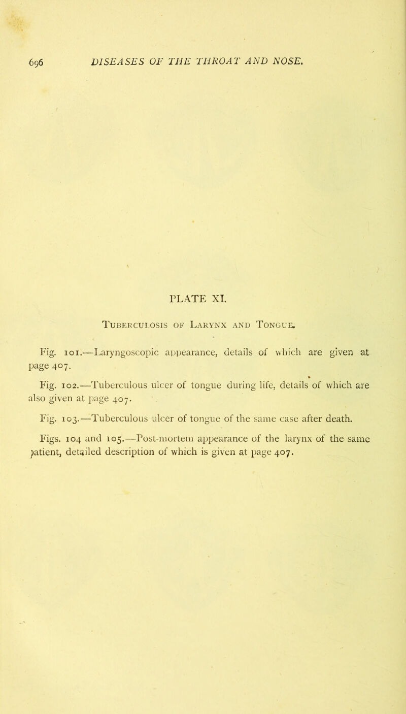PLATE XI. Tuberculosis of Larynx and Tongue. Fig. 101.—Laryngoscopic appearance, details of which are given at page 407. Fig. 102.—Tuberculous ulcer of tongue during life, details of which are also given at page 407. Fig. 103.—Tuberculous ulcer of tongue of the same case after death. Figs. 104 and 105.—Post-mortem appearance of the larynx of the same patient, detailed description of which is given at page 407.
