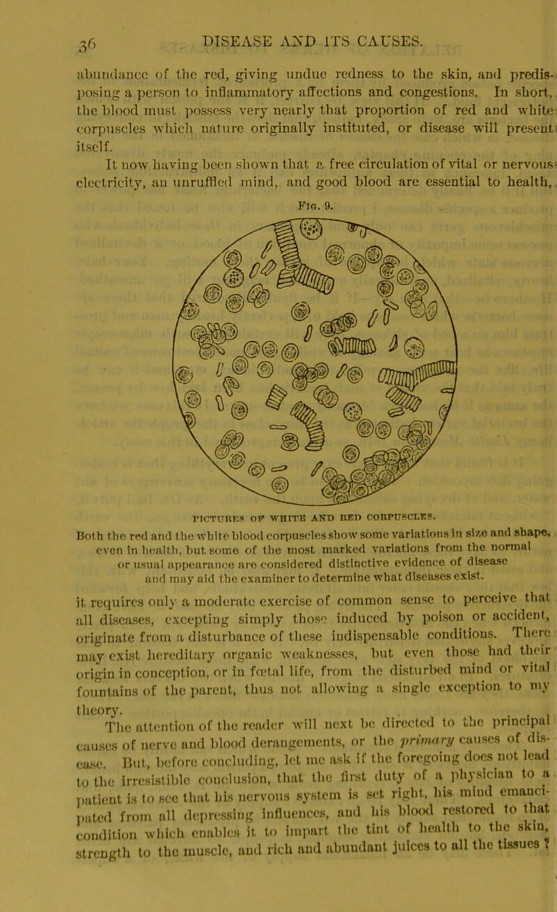 :/> abundance of the red, giving undue redness to the skin, and predis- posing a person to inflammatory affections and congestions. In short, the blood must possess very nearly that proportion of red and white corpuscles which nature originally instituted, or disease will present itself. It now having been shown that a free circulation of vital or nervous1 electricity, an unruffled mind, and good blood are essential to health. Fin. 9. PICTURES OP WHITE AND RED CORPUSCLES. Both tho red and the white blood corpuscles show some variations in size and shape, even in health, but some of the most marked variations from the normal or usual appearance are considered distinctive evidence of disease and may aid the examiner to determine what diseases exist. it requires only a moderate exercise of common sense to perceive that all diseases, excepting simply those induced by poison or accident, originate from a disturbance of these indispensable conditions. There may exist hereditary organic weaknesses, but even those had their origin in conception, or in foetal life, from the disturbed mind or vital fountains of the parent, thus not allowing a single exception to my theory. . i The attention of the reader will next be directed to the principal causes of nerve and blood derangements, or the primary causes of dis- ease. But, before concluding, let me ask if the foregoing does not lead to the irresistible conclusion, that the first duty of a physician to a patient is to see that his nervous system is set right, his mind emanci- pated from nil depressing influences, and his blood restored to that condition which enables it to impart the tint of health to the skin, strength to the muscle, and rich and abuudunt juices to all the tissues ?