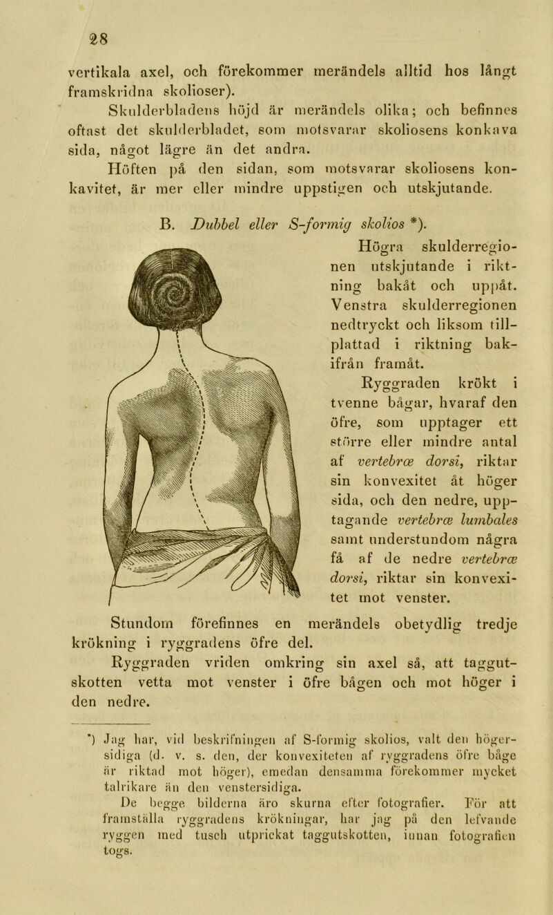 vertikala axel, och förekommer merändels alltid hos långt framskridna skolioser). Skulderbladens höjd är merändels olika; och befinnes oftast det skulderbladet, so!n motsvarar skoliosens konkava sida, något lägre än det andra. Höften på den sidan, som motsvarar skoliosens kon- kavitet, är mer eller mindre uppstigen och utskjutande. Stundom förefinnes en merändels obetydlig tredje krökning i ryggradens öfre del. Ryggraden vriden omkring sin axel så, att taggut- skotten vetta mot venster i öfre bågen och mot höger i den nedre. *) Jag liar, vid beskrifningen af S-formig skolios, valt den högcr- sidiga (d. v. s. den, der konvexitcten af lyg-gradens öfre båge är riktad mot höger), emedan densamma förekommer mycket talrikare än den venstersidiga. De begge bilderna äro skurna efter fotografier. För att framställa ryggradens krökningar, liar jag på den lefvande ryggen med tusch utprickat taggutskotten, innan fotografien togs. B. Dubbel eller S-formig skolios *). Högra skulderregio- nen utskjutande i rikt- ning bakåt och uppåt. Venstra skulderregionen nedtryckt och liksom till- plattad i riktning bak- ifrån framåt. Ryggraden krökt i tvenne bågar, hvaraf den öfre, som upptager ett större eller mindre antal af vertebrce dorsi, riktar sin konvexitet åt höger sida, och den nedre, upp- tagande vertebrce lumbales samt understundom några få af de nedre vertebrce dorsi, riktar sin konvexi- tet mot venster.