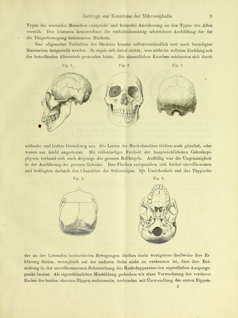 Typus- des normalen Menschen entspricht und keinerlei Annäherung an den Typus des Affen verräth. Den letzteren kennzeichnet die verhältnissmässig schwächere Ausbildung der für die Fingerbewegung bestimmten Muskeln. Das allgemeine Verhalten des Skeletes konnte selbstverständlich erst nach beendigter Maceration festgestellt werden. Es ergab sich dabei nichts, was nicht im vollsten Einklang mit der betreffenden Altersstufe gestanden hätte. Die sämintlichen Knochen zeichneten sich durch Fig. 1. Fig. 2. Fig. 3. schlanke und leichte Gestaltung aus. Die Linien der Muskelansätze fehlten noch gänzlich, oder waren nur leicht angedeutet. Mit vollständiger Freiheit der hauptsächlichsten Gelenkepi- physen verband sich auch diejenige des grossen Rnllhiigels. Auffällig war die Ungenauigkeit in der Ausführung der grossen Gelenke. Ihre Flächen entsprachen sich höchst unvollkommen und bedingten dadurch den Charakter des Schlottrigen. Die Unsicherheit und das Täppische Fig. 4. Fig, 5. der an der Lebenden beobachteten Bewegungen dürften darin wenigstens theilweise ihre Er klärung finden, wenngleich auf der anderen Seite nicht zu verkennen ist, dass ihre Ent- stehung in der unvollkommenen Beherrschung des Muskelapparates den eigentlichen Ausgangs- punkt besitzt. Als eigenthümlicher Missbildung gedenken wir einer Verwachsung der vorderen Enden der beiden obersten Rippen rechterseits, verbunden mit Umwandlung des ersten Rippen- 2