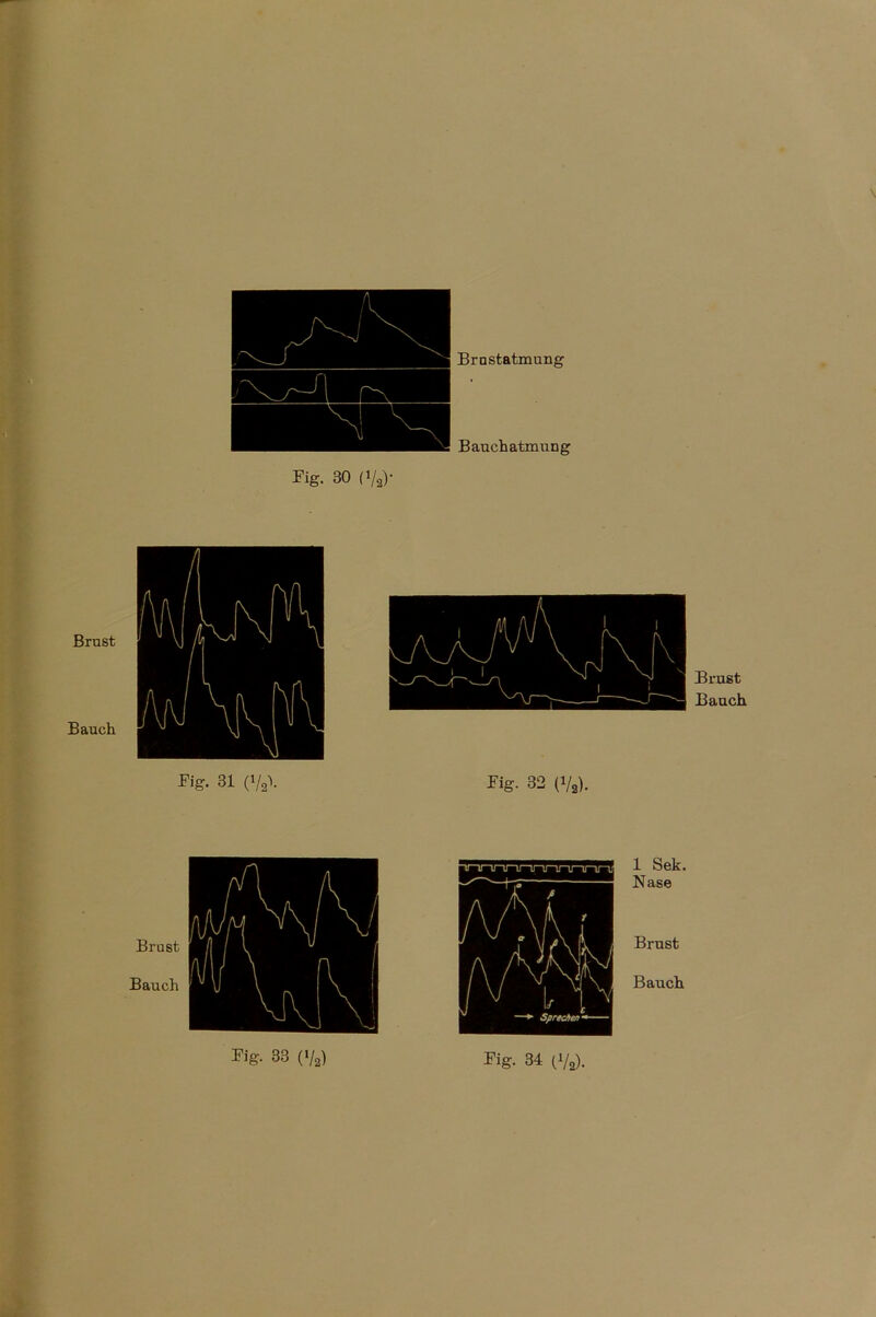 \ Brnstatmung Bauchatmung Fig. 30 (Va)* Brust Bauch Brust Bauch Big. 31 (i/a\ Fig- 32 (Va). Brust Bauch 1 Sek. Nase Brust Bauch
