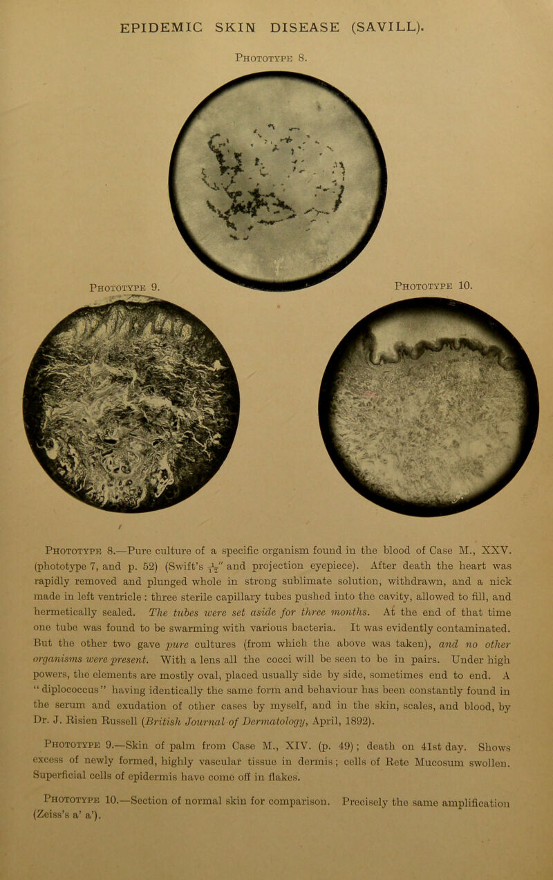 EPIDEMIC SKIN DISEASE (SAVILL). Phototype 8. / Phototype 8.—Pure culture of a specific organism found in the blood of Case M., XXV. (phototype 7, and p. 52) (Swift’s Th and projection eyepiece). After death the heart was rapidly removed and plunged whole in strong sublimate solution, withdrawn, and a nick made in left ventricle : three sterile capillary tubes pushed into the cavity, allowed to fill, and hermetically sealed. The tubes ivere set aside for three months. At the end of that time one tube was found to be swarming with various bacteria. It was evidently contaminated. But the other two gave pure cultures (from which the above was taken), and no other organisms were present. With a lens all the cocci will be seen to be in pairs. Under high powers, the elements are mostly oval, placed usually side by side, sometimes end to end. A “ diplococcus” having identically the same form and behaviour has been constantly found in the serum and exudation of other cases by myself, and in the skin, scales, and blood, by Dr. J. Risien Russell (British Journal of Dermatology, April, 1892). Phototype 9.—Skin of palm from Case M., XIV. (p. 49) ; death on 41st day. Shows excess of newly formed, highly vascular tissue in dermis; cells of Rete Mucosum swollen. Superficial cells of epidermis have come off in flakes. Phototype 10.—Section of normal skin for comparison. Precisely the same amplification (Zeiss’s a’ a’).