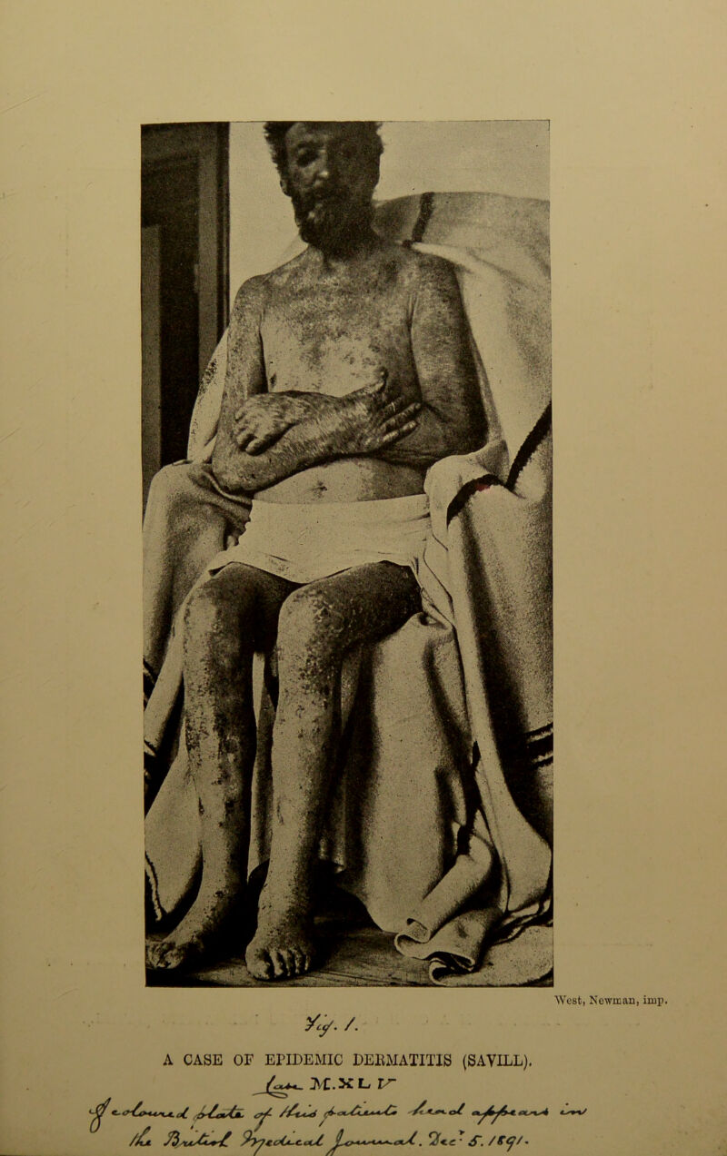 West, Newman, imp. Xy. /. /• A CASE OF EPIDEMIC DERMATITIS (SAVILL). M.XL IS 25j*>c/u*^ '2y74.c4juc.cc/. jL<>~cc*uc*-<Xs2. . !?<C ‘