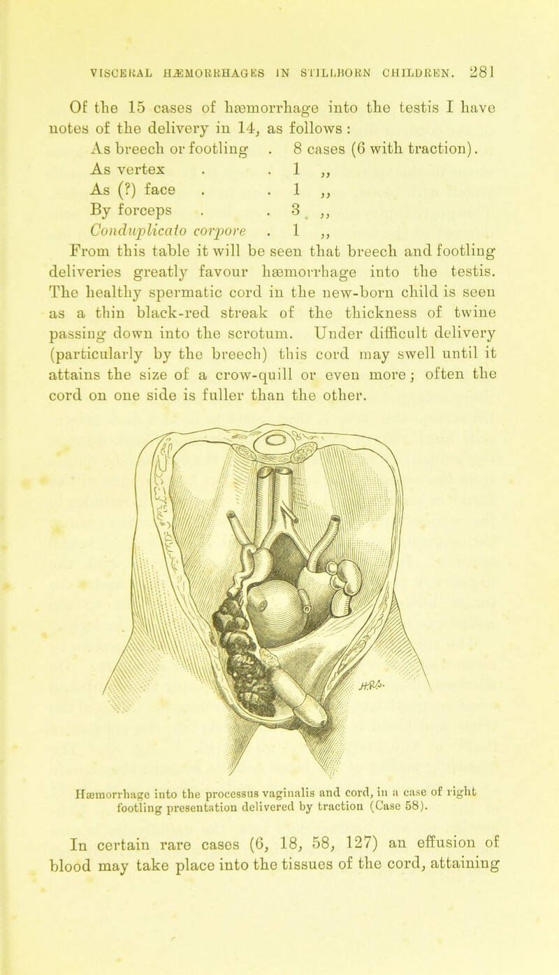 Of the 15 cases of haemorrhage into the testis I have notes of the delivery in 14, as follows : As breech or footling . 8 cases (6 with traction). As vertex . 1 „ As (?) face . 1 ,, By forceps . 3 ,, Condwplicato eorpore . 1 ,, From this table it will be seen that breech and footling deliveries greatly favour haemorrhage into the testis. The healthy spermatic cord in the new-born child is seen as a thin black-red streak of the thickness of twine passing down into the scrotum. Under difficult delivery (particularly by the breech) this cord may swell until it attains the size of a crow-quill or even more; often the cord on one side is fuller than the other. Ilannorrhage into the processus vaginalis and cord, in a case of right footling presentation delivered by traction (Case 58). In certain rare cases (6, 18, 58, 127) an effusion of blood may take place into the tissues of the cord, attaining