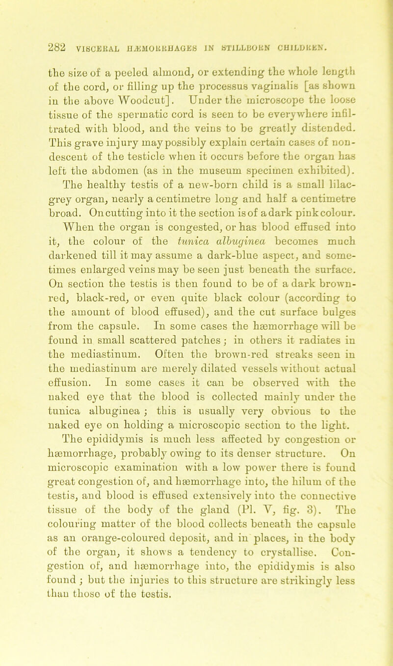 the size of a peeled almond, or extending the whole length of the cord, or filling up the processus vaginalis [as shown in the above Woodcut]. Under the microscope the loose tissue of the spermatic cord is seen to be everywhere in61- trated with blood, and the veins to be greatly distended. This grave injury may possibly explain certain cases of non- descent of the testicle when it occurs before the organ has left the abdomen (as in the museum specimen exhibited). The healthy testis of a new-born child is a small lilac- grey organ, nearly a centimetre long and half a centimetre broad. On cutting into it the section is of a dark pink colour. When the organ is congested, or has blood effused into it, the colour of the tunica albuginea becomes much darkened till it may assume a dark-blue aspect, and some- times enlarged veins may be seen just beneath the surface. On section the testis is then found to be of a dark brown- red, black-red, or even quite black colour (according to the amount of blood effused), and the cut surface bulges from the capsule. In some cases the haemorrhage will be found in small scattered patches; in others it radiates in the mediastinum. Often the brown-red streaks seen in the mediastinum are merely dilated vessels without actual effusion. In some cases it can be observed with the naked eye that the blood is collected mainly under the tunica albuginea; this is usually very obvious to the naked eye on holding a microscopic section to the light. The epididymis is much less affected by congestion or haemorrhage, probably owing to its denser structure. On microscopic examination with a low power there is found great congestion of, and haemorrhage into, the hilum of the testis, and blood is effused extensively into the connective tissue of the body of the gland (PI. V, fig. 3). The colouring matter of the blood collects beneath the capsule as an orange-coloured deposit, and in places, in the body of the organ, it shows a tendency to crystallise. Con- gestion of, and haemorrhage into, the epididymis is also found ; but the injuries to this structure are strikingly less than those of the testis.