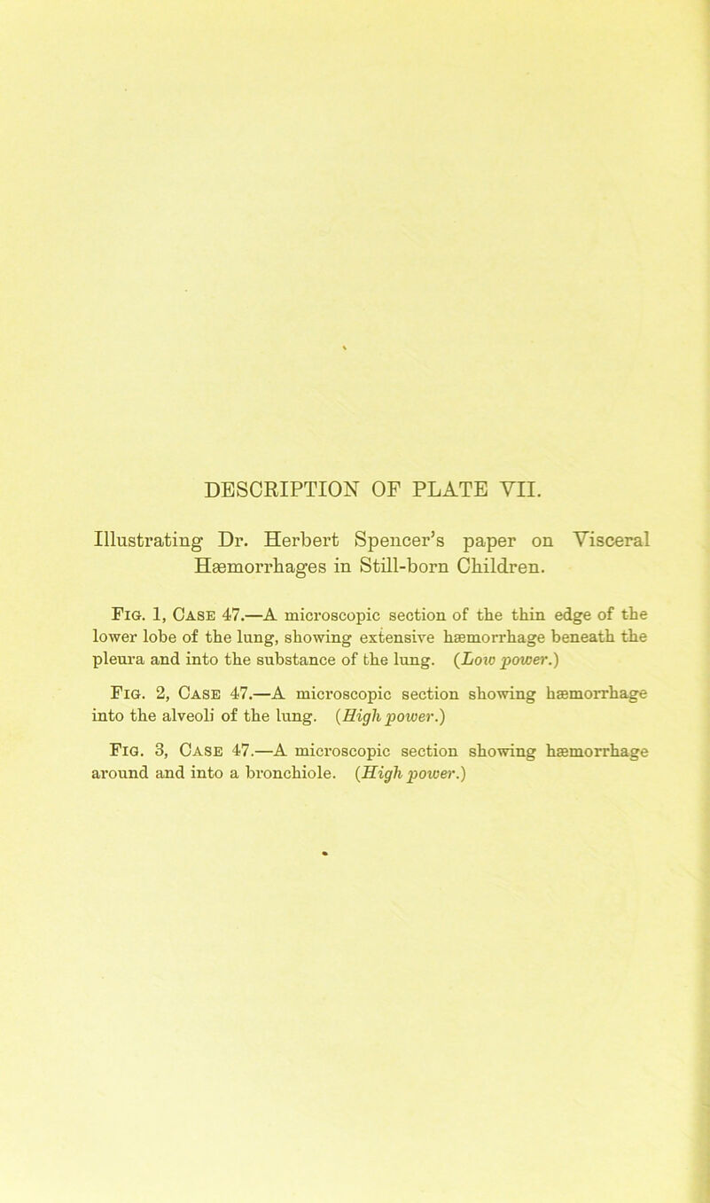 Illustrating Dr. Herbert Spencer’s paper on Visceral Haemorrhages in Still-born Children. Fig. 1, Case 47.—A microscopic section of the thin edge of the lower lobe of the lung, showing extensive hemorrhage beneath the pleura and into the substance of the lung. (Low power.) Fig. 2, Case 47.—A microscopic section showing hemorrhage into the alveoli of the lung. {High power.) Fig. 3, Case 47.—A microscopic section showing hemorrhage around and into a bronchiole. {High power.)