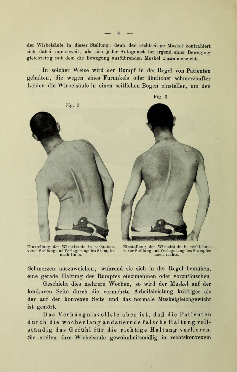 der Wirbelsäule in dieser Stellung, denn der rechtseitige Muskel kontrahiert sich dabei nur soweit, als sich jeder Antagonist bei irgend einer Bewegung gleichzeitig mit dem die Bewegung ausführenden Muskel zusammenzieht. In solcher Weise wird der Rumpf in der Regel von Patienten gehalten, die wegen eines Furunkels oder ähnlicher schmerzhafter Leiden die Wirbelsäule in einen seitlichen Bogen einstellen, um den Emsteilung der Wirbelsäule in rechtskon- vexer Stellung und Verlagerung des Stumpfes nach links. Einstellung der Wirbelsäule in rechtskon- vexer Stellung und Verlagerung des Stumpfes nach rechts. Schmerzen auszuweichen, während sie sich in der Regel bemühen, eine gerade Haltung des Rumpfes einzunehmen oder vorzutäuschen. Geschieht dies mehrere Wochen, so wird der Muskel auf der konkaven Seite durch die vermehrte Arbeitsleistung kräftiger als der auf der konvexen Seite und das normale Muskelgleichgewicht ist gestört. Das Verhängnisvollste aber ist, daß die Patienten durch die wochenlang andauernde falsche Haltung voll- ständig das Gefühl für die richtige Haltung verlieren. Sie stellen ihre Wirbelsäule gewohnheitsmäßig in rechtskonvexem