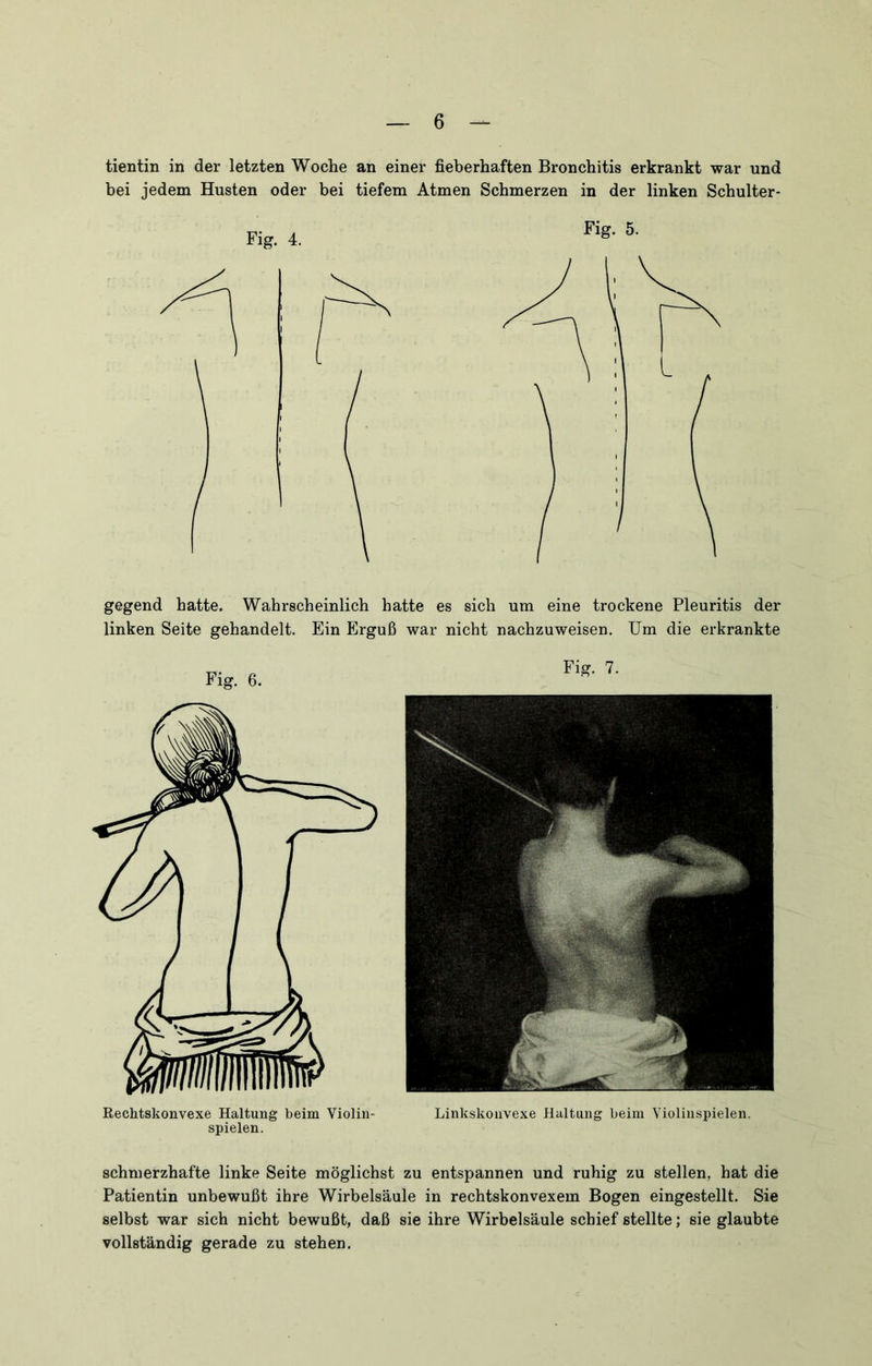 tientin in der letzten Woche an einer fieberhaften Bronchitis erkrankt war und bei jedem Husten oder bei tiefem Atmen Schmerzen in der linken Schulter- Fig. 4. Fig. 5. gegend hatte. Wahrscheinlich hatte es sich um eine trockene Pleuritis der linken Seite gehandelt. Ein Erguß war nicht nachzuweisen. Um die erkrankte Fig. 6. Rechtskonvexe Haltung beim Violin- spielen. Fig. 7. Linkskoiivexe Haltung beim Violinspielen. schmerzhafte linke Seite möglichst zu entspannen und ruhig zu stellen, hat die Patientin unbewußt ihre Wirbelsäule in rechtskonvexem Bogen eingestellt. Sie selbst war sich nicht bewußt, daß sie ihre Wirbelsäule schief stellte; sie glaubte vollständig gerade zu stehen.