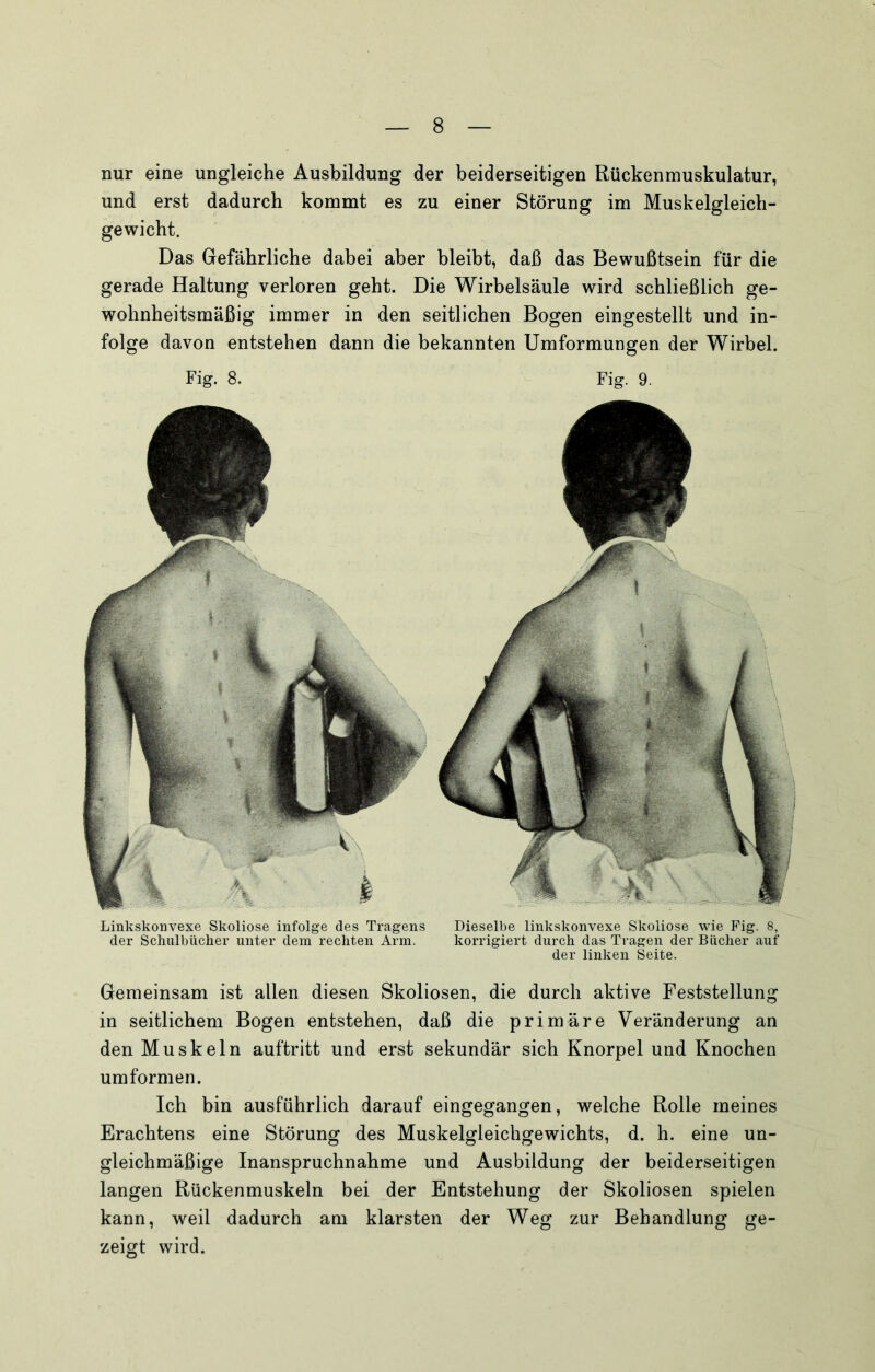 nur eine ungleiche Ausbildung der beiderseitigen Rückenmuskulatur, und erst dadurch kommt es zu einer Störung im Muskelgleicb- gewicht. Das Gefährliche dabei aber bleibt, daß das Bewußtsein für die gerade Haltung verloren geht. Die Wirbelsäule wird schließlich ge- wohnheitsmäßig immer in den seitlichen Bogen eingestellt und in- folge davon entstehen dann die bekannten Umformungen der Wirbel. Fig. 8. Fig. 9. Linkskonvexe Skoliose infolge des Tragens Dieselbe linkskonvexe Skoliose wie Fig. 8, der Schulbücher unter dem rechten Arm. korrigiert durch das Tragen der Bücher auf der linken Seite. Gemeinsam ist allen diesen Skoliosen, die durch aktive Feststellung in seitlichem Bogen entstehen, daß die primäre Veränderung an den Muskeln auftritt und erst sekundär sich Knorpel und Knochen umformen. Ich bin ausführlich darauf eingegangen, welche Rolle meines Erachtens eine Störung des Muskelgleichgewichts, d. h. eine un- gleichmäßige Inanspruchnahme und Ausbildung der beiderseitigen langen Rückenmuskeln bei der Entstehung der Skoliosen spielen kann, weil dadurch am klarsten der Weg zur Behandlung ge- zeigt wird.