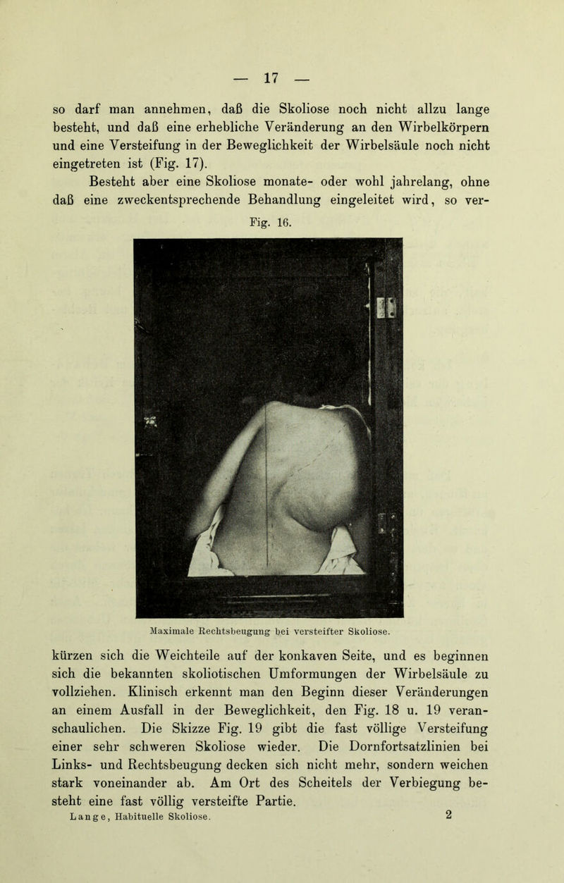 so darf man annehmen, daß die Skoliose noch nicht allzu lange besteht, und daß eine erhebliche Veränderung an den Wirbelkörpern und eine Versteifung in der Beweglichkeit der Wirbelsäule noch nicht eingetreten ist (Fig. 17). Besteht aber eine Skoliose monate- oder wohl jahrelang, ohne daß eine zweckentsprechende Behandlung eingeleitet wird, so ver- Fig. 16. Maximale Rechtsbeugung bei versteifter Skoliose. kürzen sich die Weichteile auf der konkaven Seite, und es beginnen sich die bekannten skoliotischen Umformungen der Wirbelsäule zu vollziehen. Klinisch erkennt man den Beginn dieser Veränderungen an einem Ausfall in der Beweglichkeit, den Fig. 18 u. 19 veran- schaulichen. Die Skizze Fig. 19 gibt die fast völlige Versteifung einer sehr schweren Skoliose wieder. Die Dornfortsatzlinien bei Links- und Rechtsbeugung decken sich nicht mehr, sondern weichen stark voneinander ab. Am Ort des Scheitels der Verbiegung be- steht eine fast völlig versteifte Partie. Lange, Habituelle Skoliose. 2