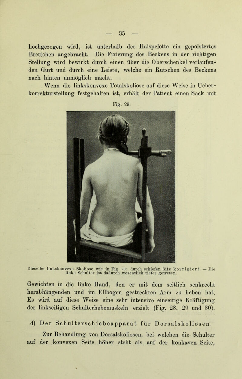 hochgezogen wird, ist unterhalb der Halspelotte ein gepolstertes Brettchen angebracht. Die Fixierung des Beckens in der richtigen Stellung wird bewirkt durch einen über die Oberschenkel verlaufen- den Gurt und durch eine Leiste, welche ein Rutschen des Beckens nach hinten unmöglich macht. Wenn die linkskonvexe Totalskoliose auf diese Weise in Ueber- korrekturstellung festgehalten ist, erhält der Patient einen Sack mit Fig. 29. Dieselbe linkskonvexe Skoliose wie in Fig. 28; durch schiefen Sitz korrigiert. — Die linke Schulter ist dadurch wesentlich tiefer getreten. Gewichten in die linke Hand, den er mit dem seitlich senkrecht herabhängenden und im Ellbogen gestreckten Arm zu heben hat. Es wird auf diese Weise eine sehr intensive einseitige Kräftigung der linkseitigen Schulterhebemuskeln erzielt (Fig. 28, 29 und 30). d) Der Schulterschiebeapparat für Dorsalskoliosen. Zur Behandlung von Dorsalskoliosen, bei welchen die Schulter auf der konvexen Seite höher steht als auf der konkaven Seite,